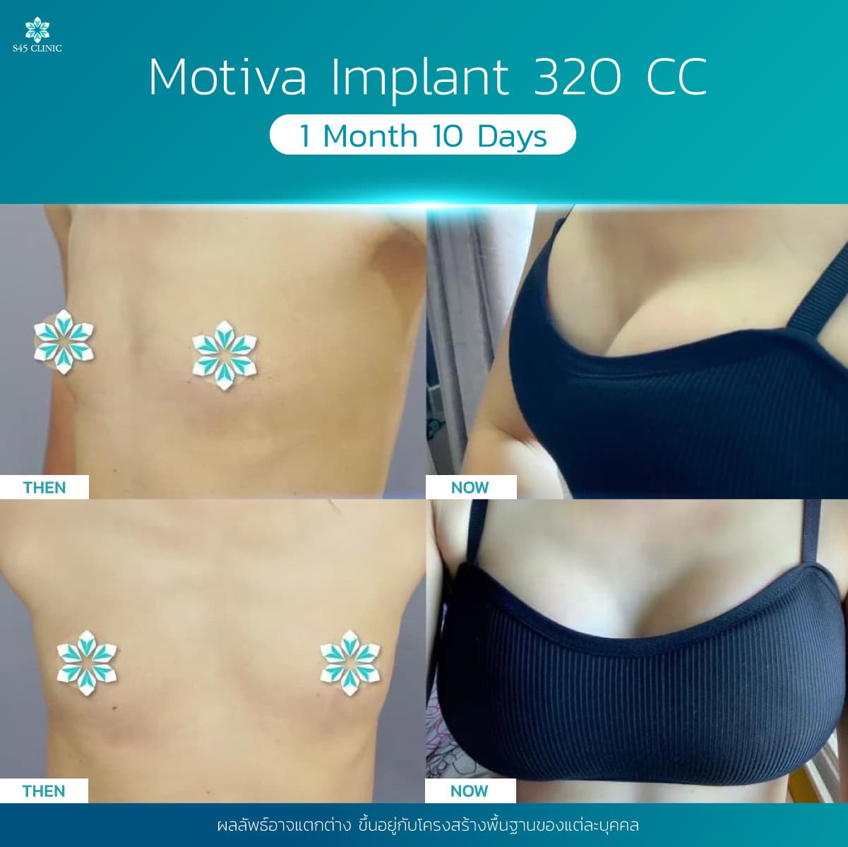 motiva implant 320 cc.