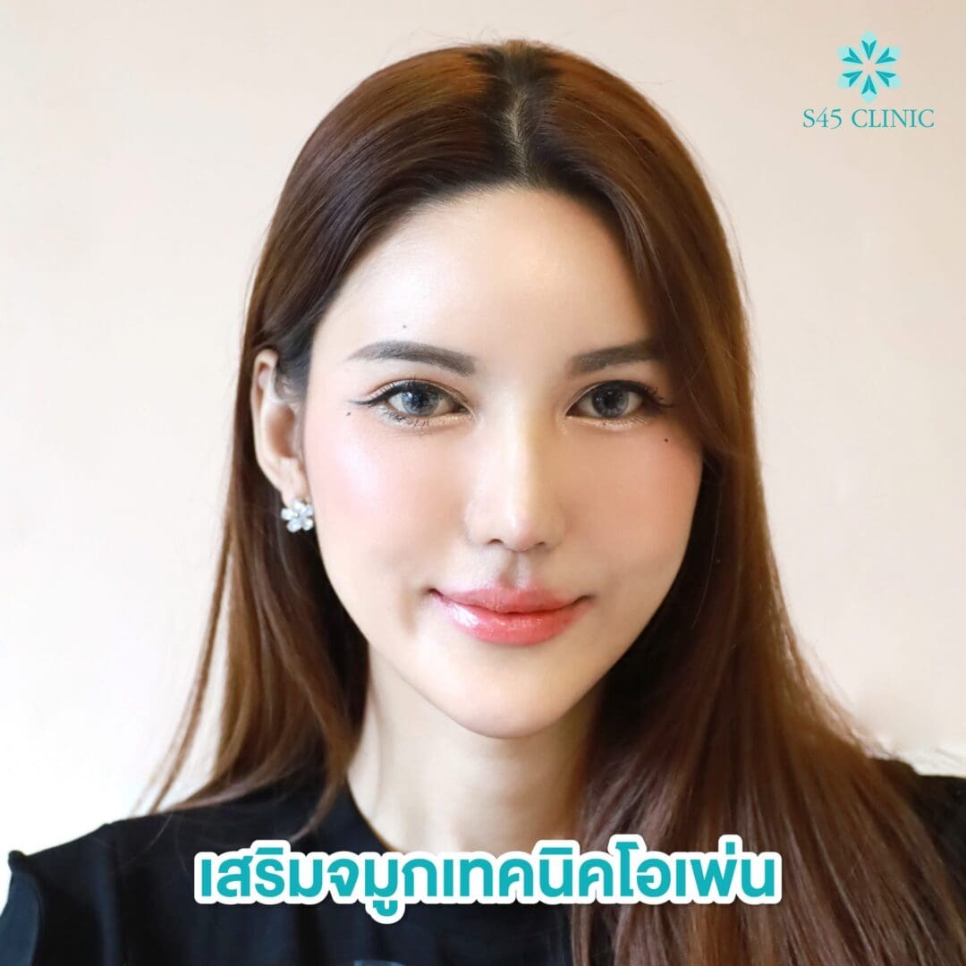 Rhinoplasty Secret:เสริมจมูกด้วยกระดูกอ่อนคนอื่น ได้ไหม 7 จมูกทรงตุรกี