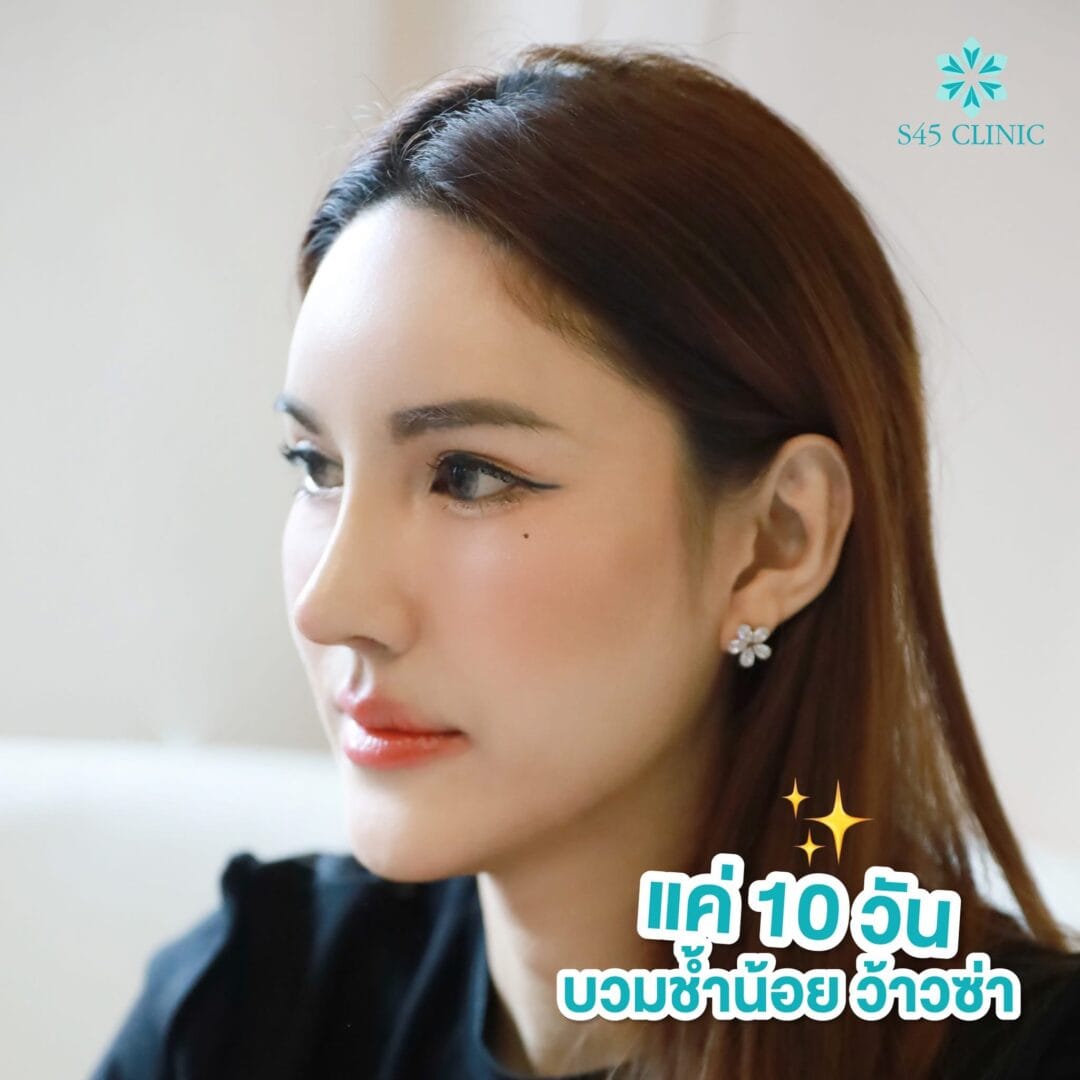 Rhinoplasty Secret:เสริมจมูกด้วยกระดูกอ่อนคนอื่น ได้ไหม 6 จมูกทรงตุรกี
