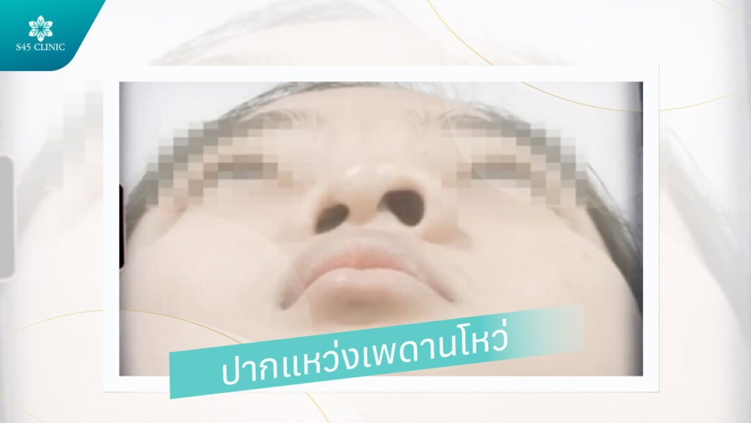 Restore & Refine รักษาปากแหว่งเพดานโหว่ก่อนเสริม 2 ปากแหว่งเพดานโหว่
