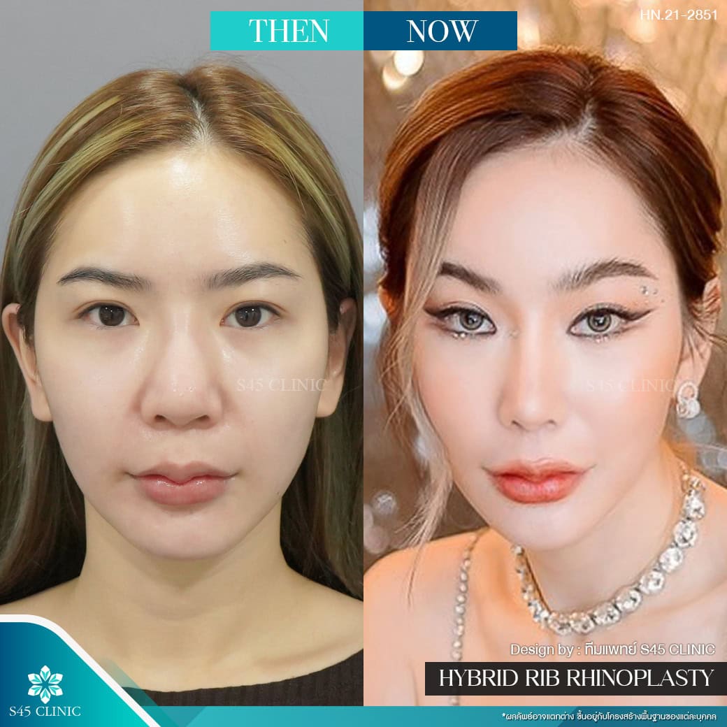 แก้จมูก รีวิวลูกค้าจริง