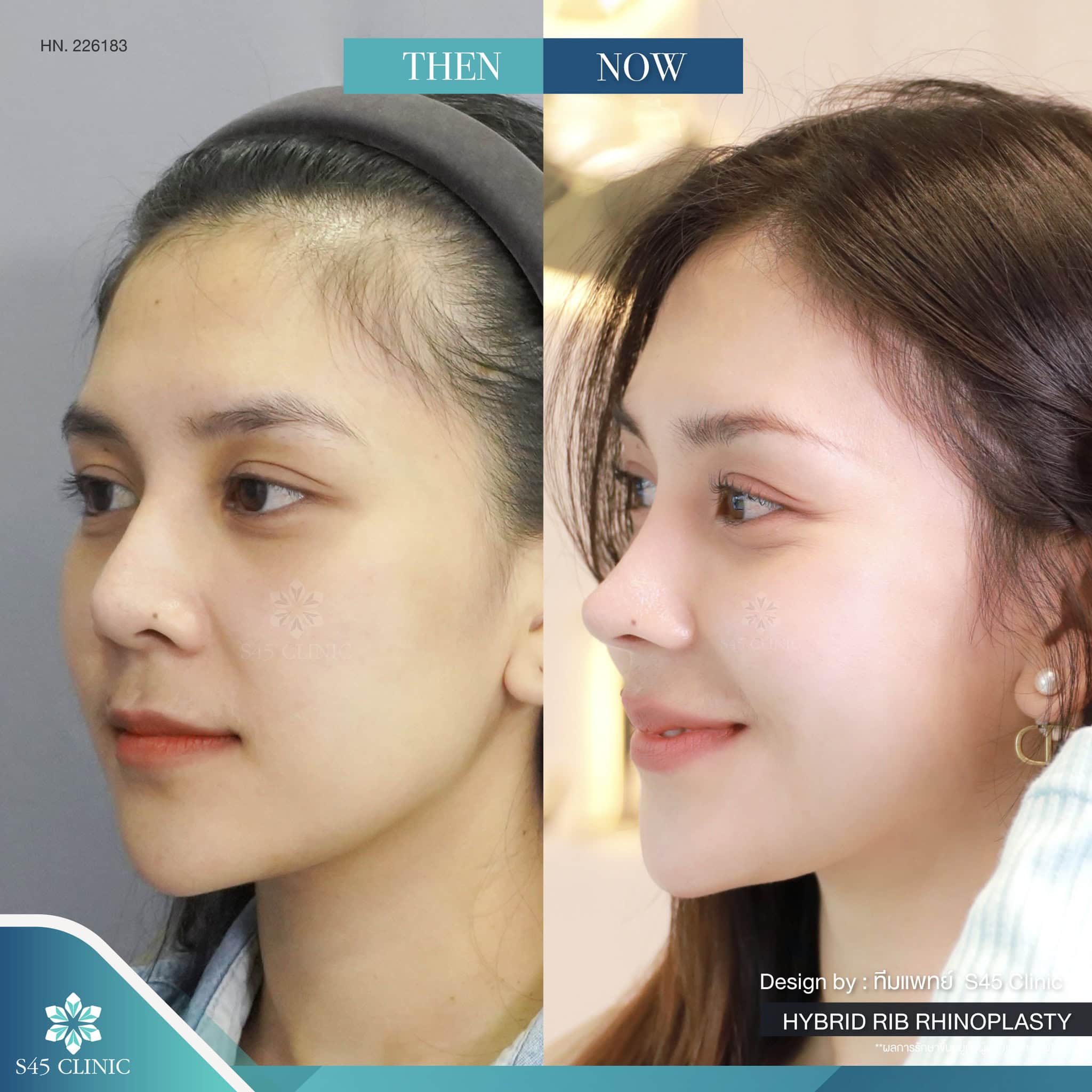 แก้จมูก รีวิวลูกค้าจริง