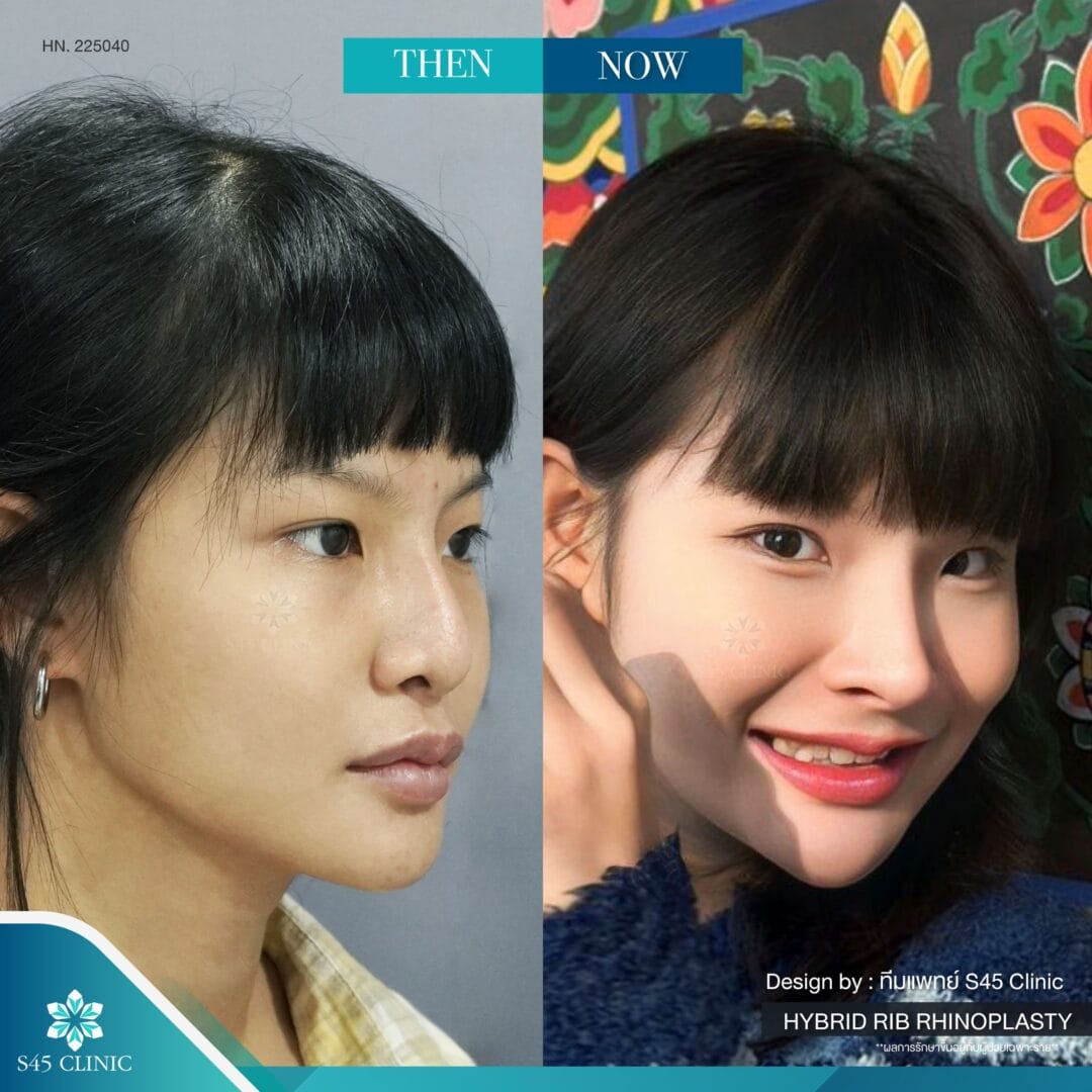 แก้จมูก รีวิวลูกค้าจริง