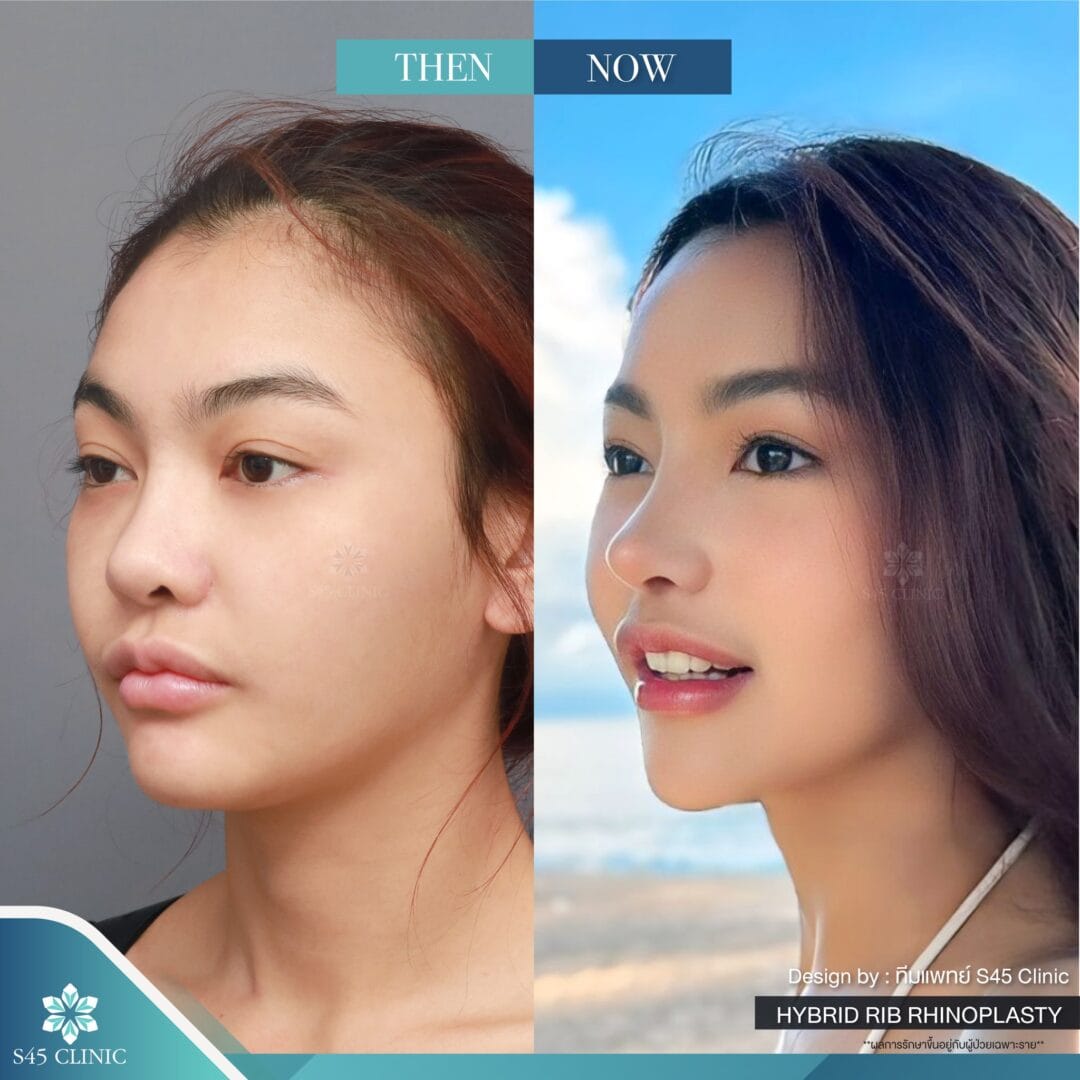 แก้จมูก รีวิวลูกค้าจริง
