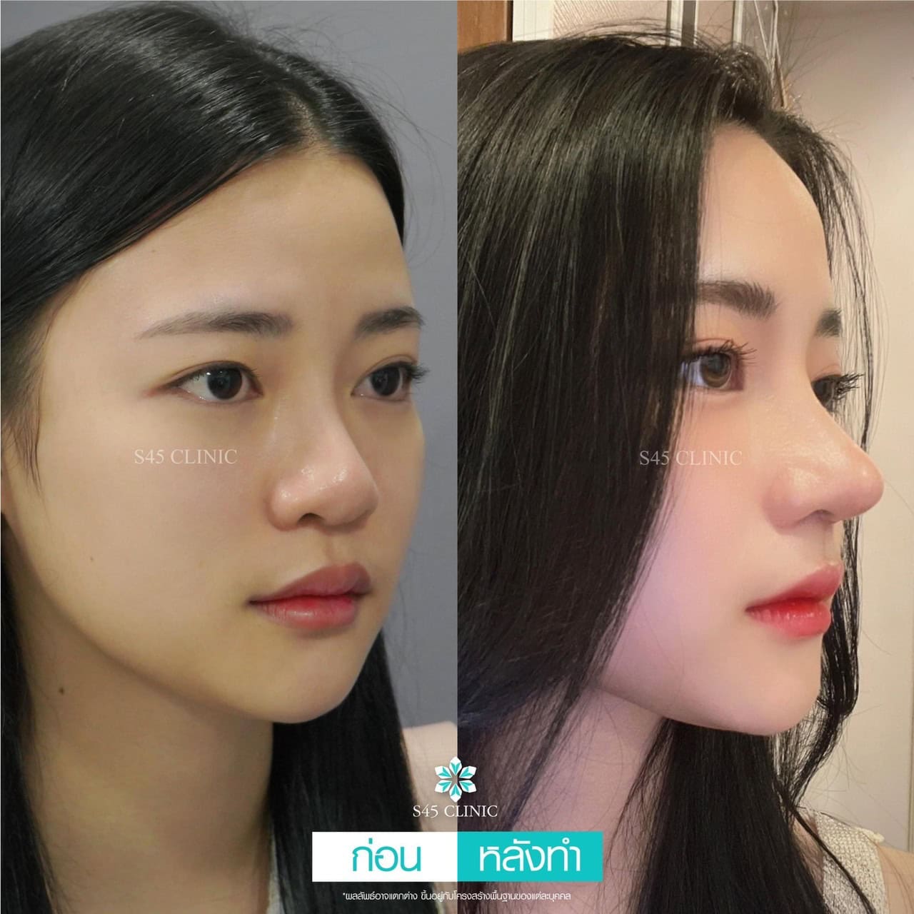 แก้จมูก รีวิวลูกค้าจริง