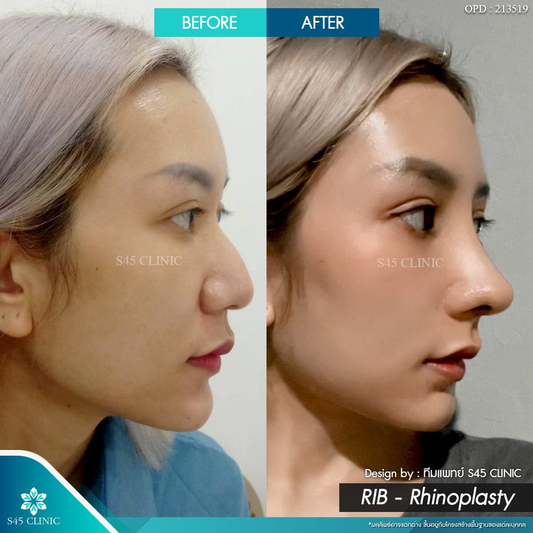 แก้จมูก รีวิวลูกค้าจริง