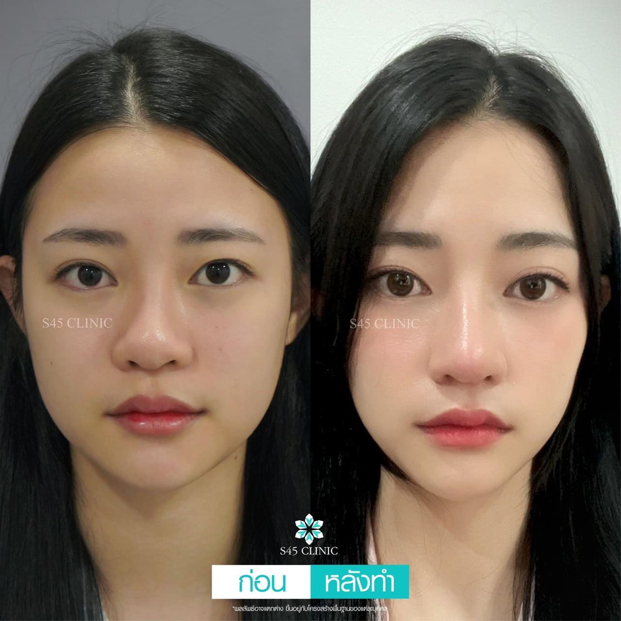แก้จมูก รีวิวลูกค้าจริง