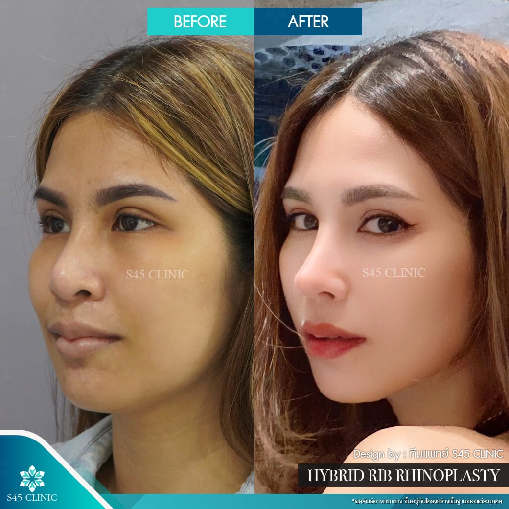แก้จมูก รีวิวลูกค้าจริง