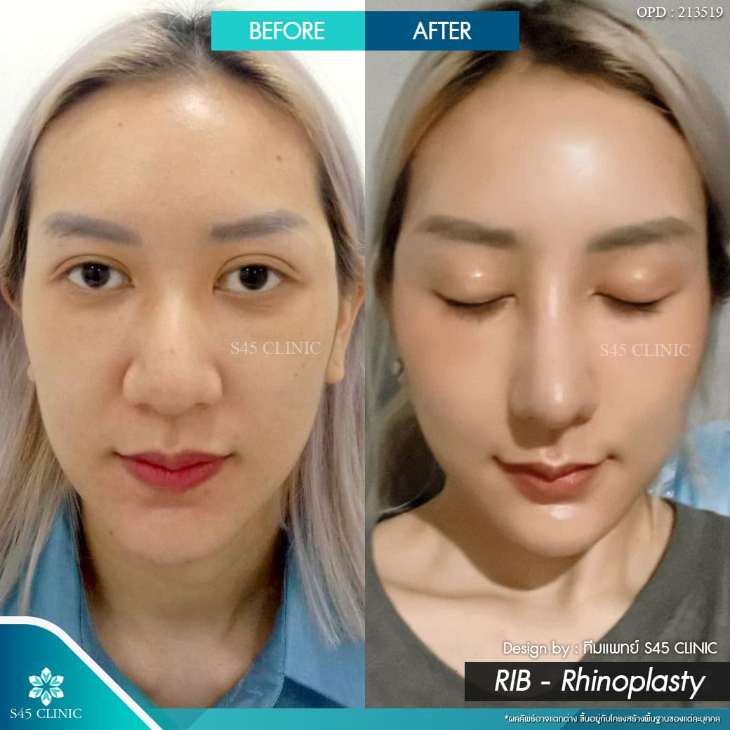 แก้จมูก รีวิวลูกค้าจริง