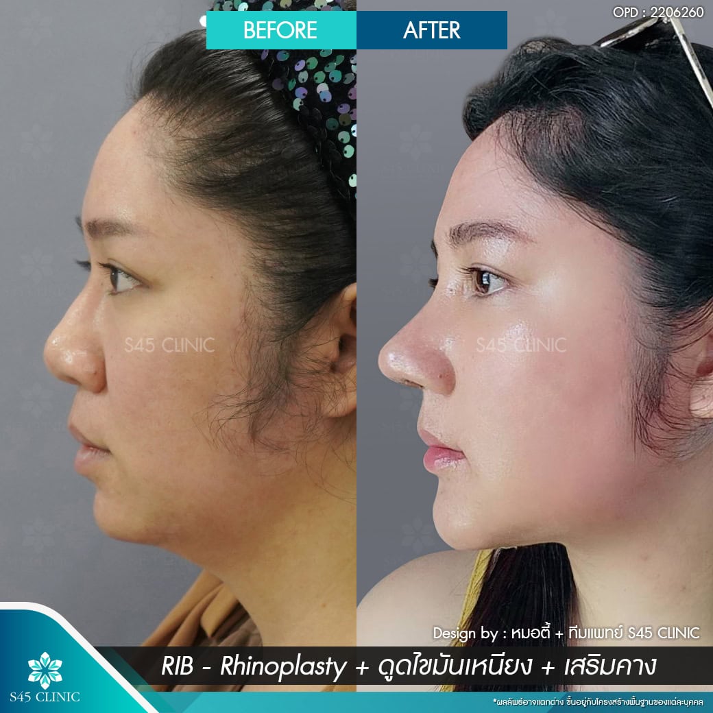 แก้จมูก รีวิวลูกค้าจริง