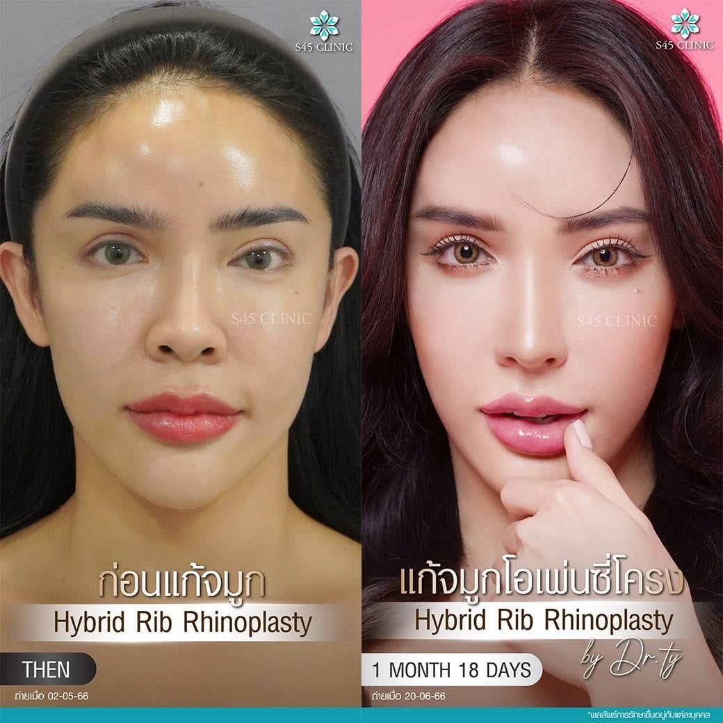 แก้จมูก รีวิวลูกค้าจริง