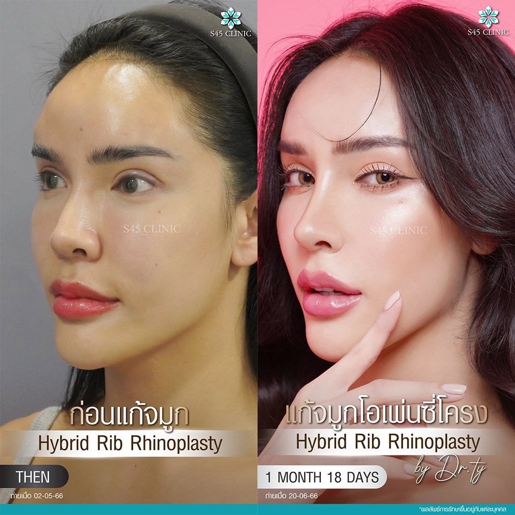 แก้จมูก รีวิวลูกค้าจริง