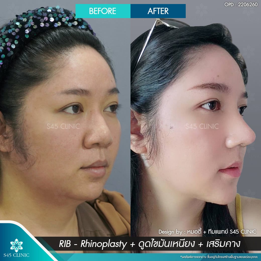 แก้จมูก รีวิวลูกค้าจริง