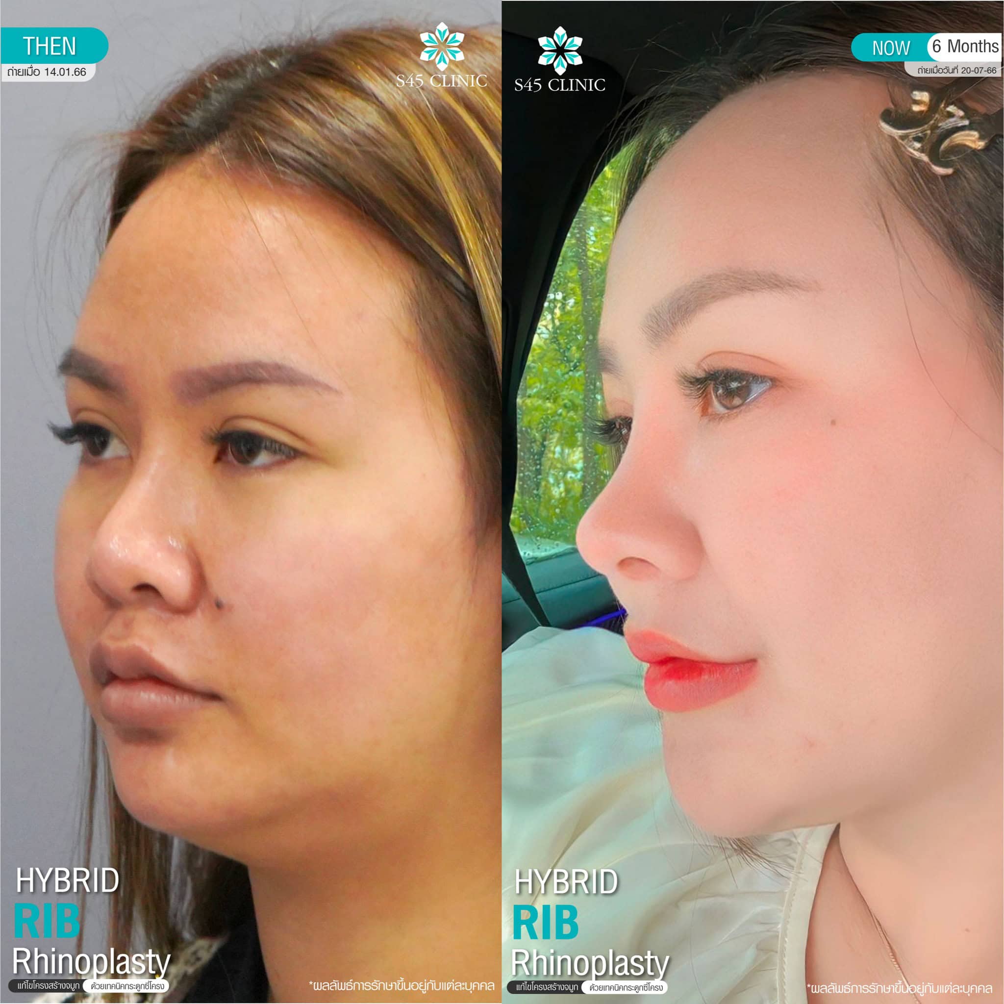 แก้จมูก รีวิวลูกค้าจริง