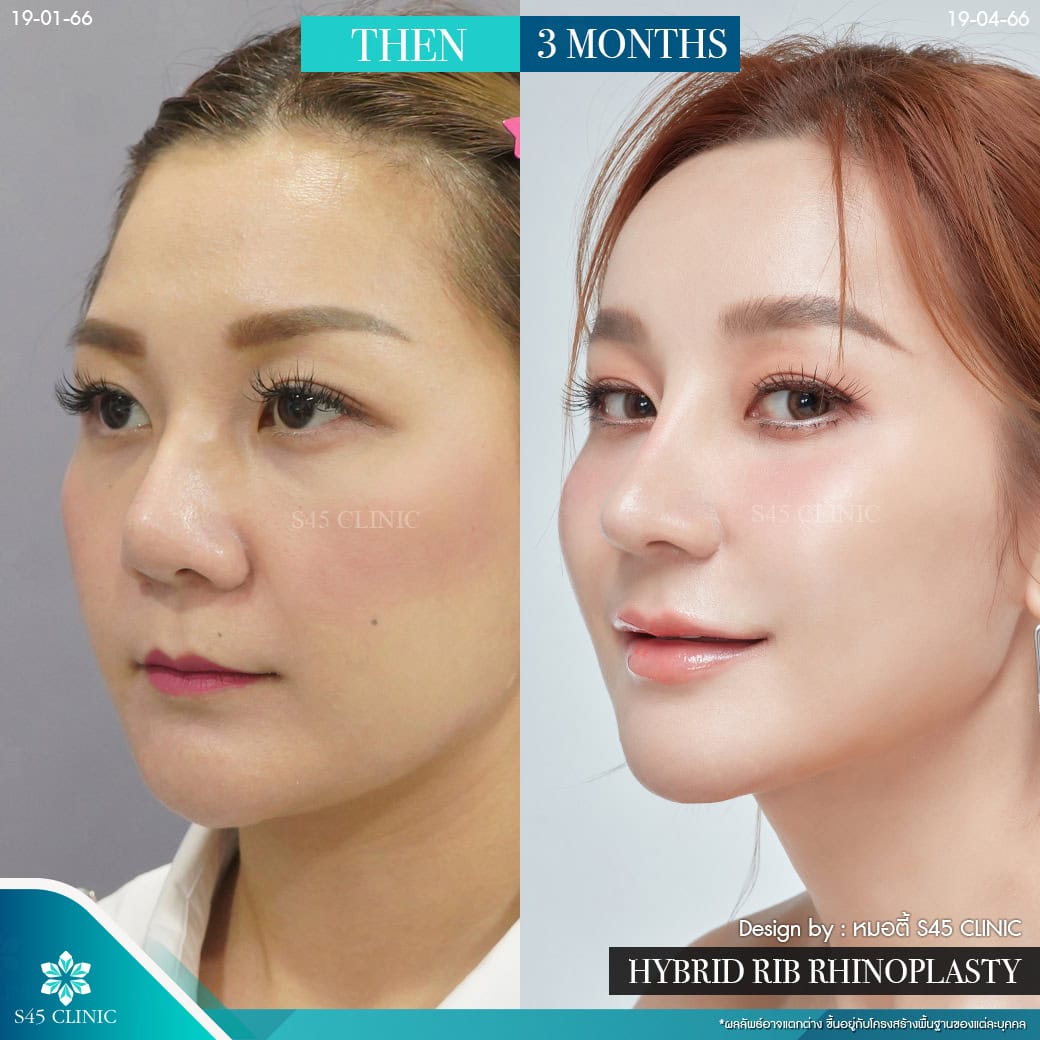 แก้จมูก รีวิวลูกค้าจริง