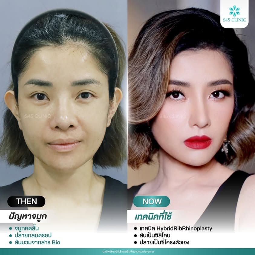 แก้จมูก รีวิวลูกค้าจริง