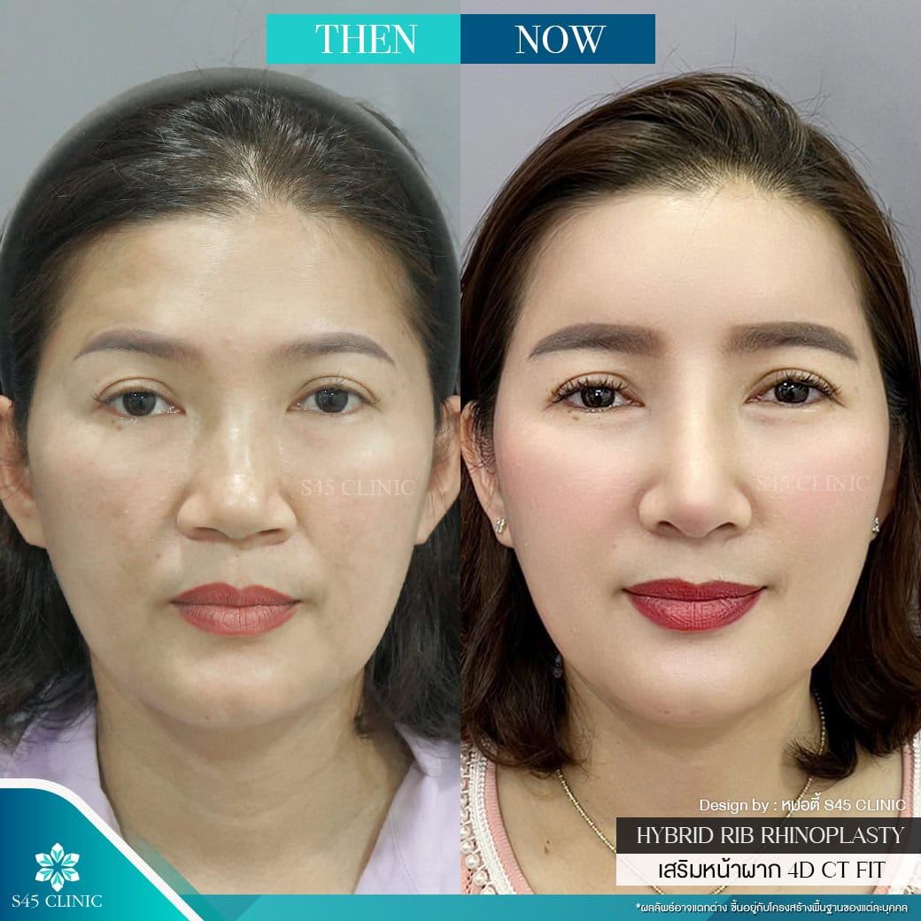 แก้จมูก รีวิวลูกค้าจริง