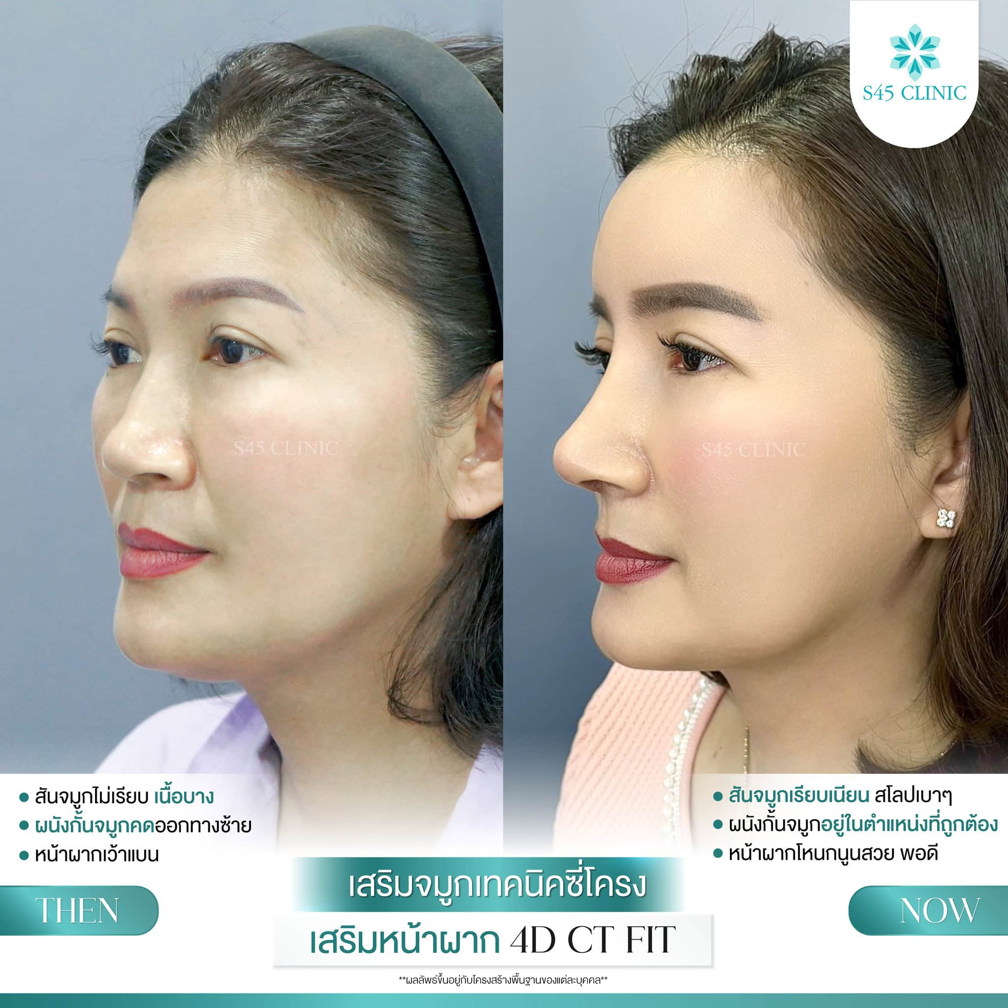 แก้จมูก รีวิวลูกค้าจริง