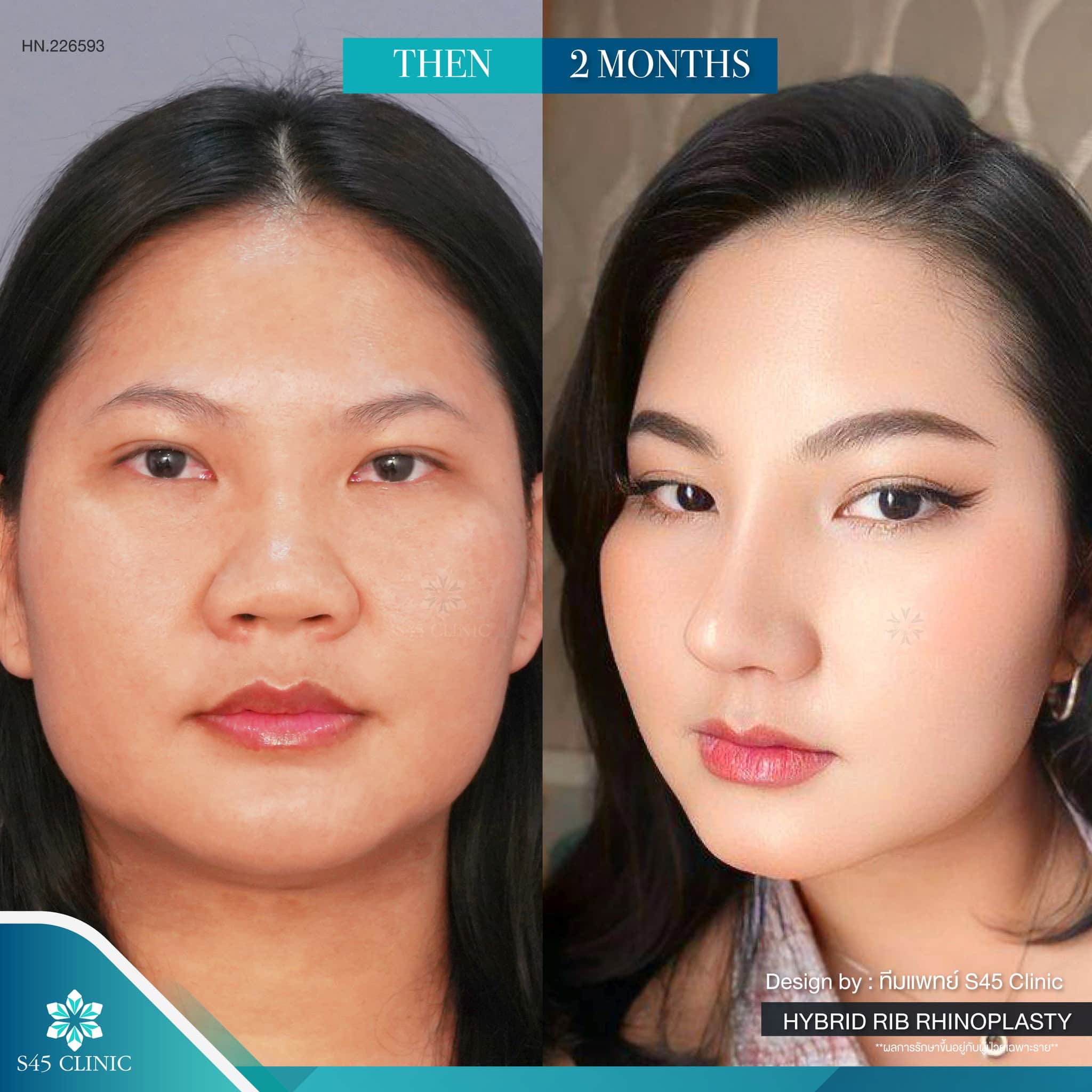 แก้จมูก รีวิวลูกค้าจริง