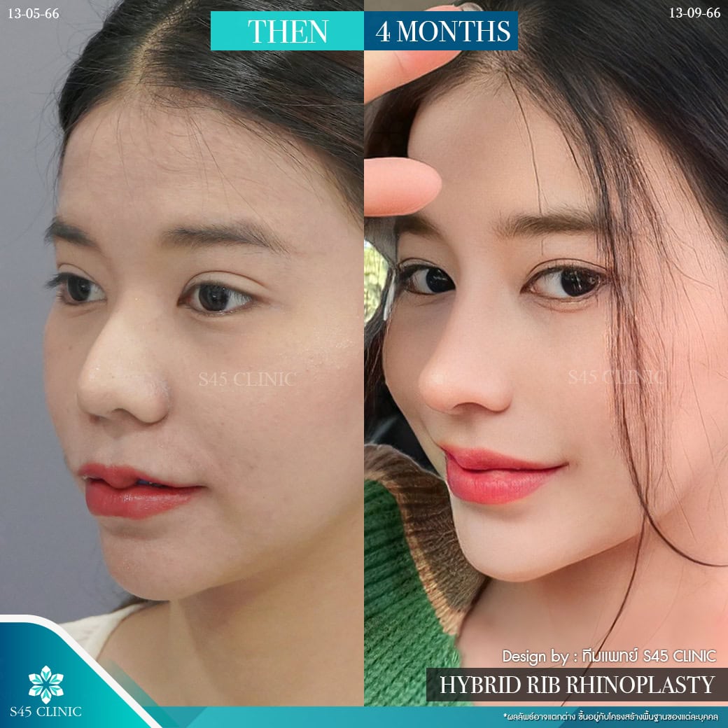 แก้จมูก รีวิวลูกค้าจริง
