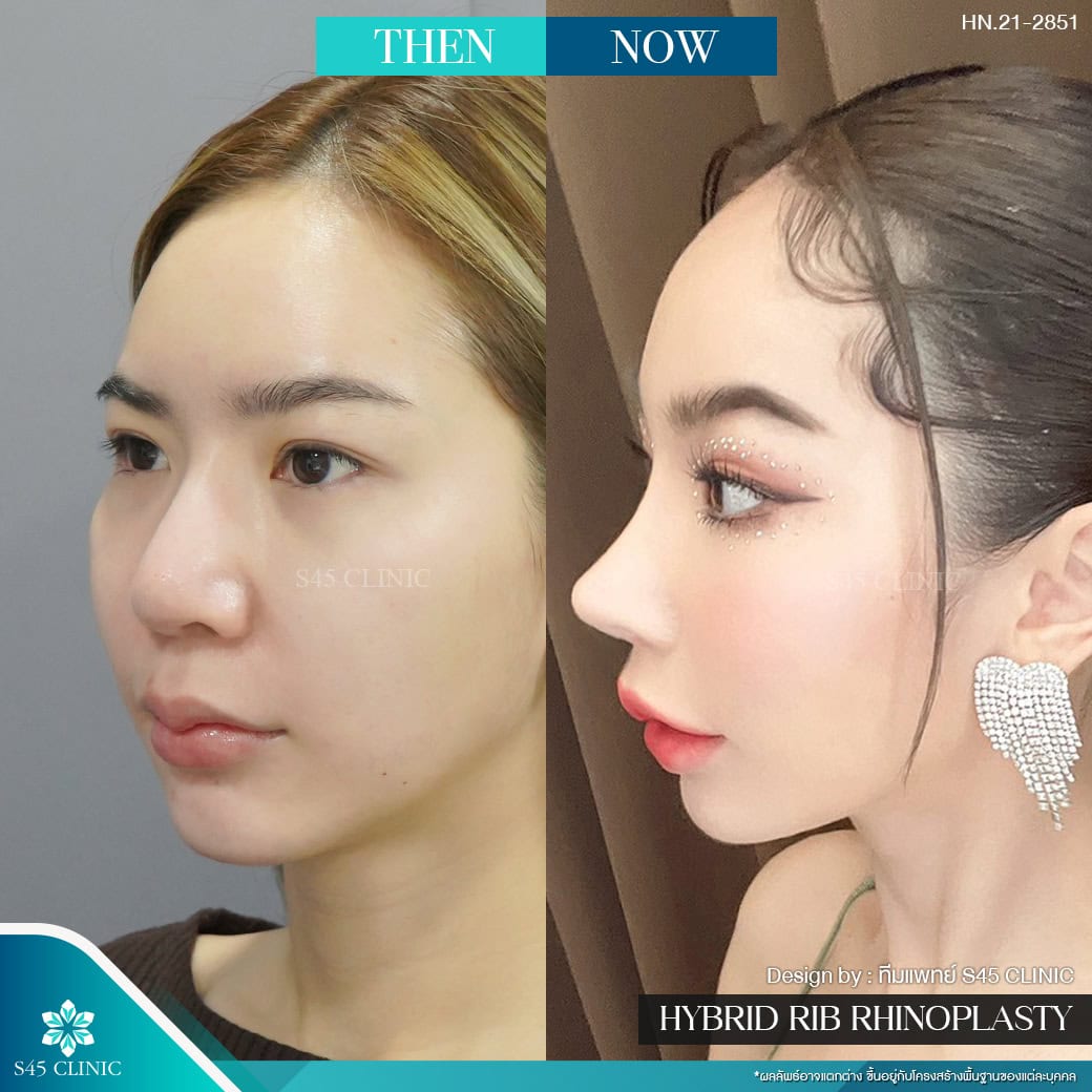 แก้จมูก รีวิวลูกค้าจริง