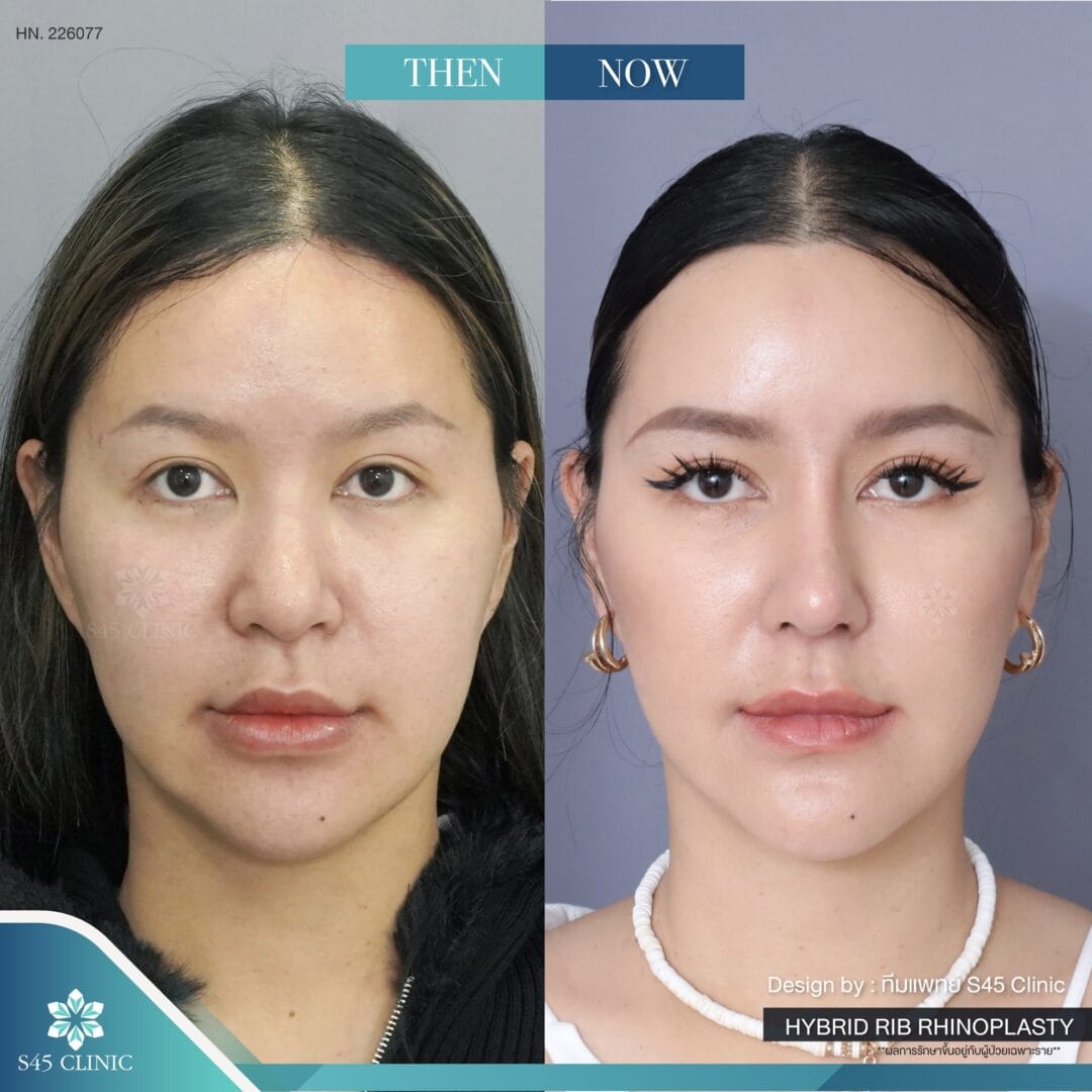 แก้จมูก รีวิวลูกค้าจริง