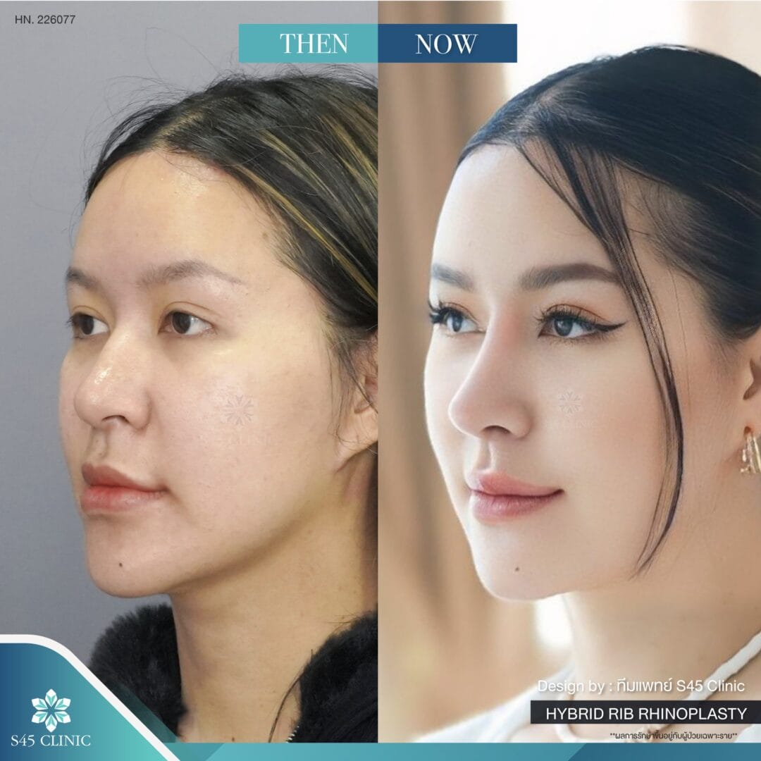 แก้จมูก รีวิวลูกค้าจริง
