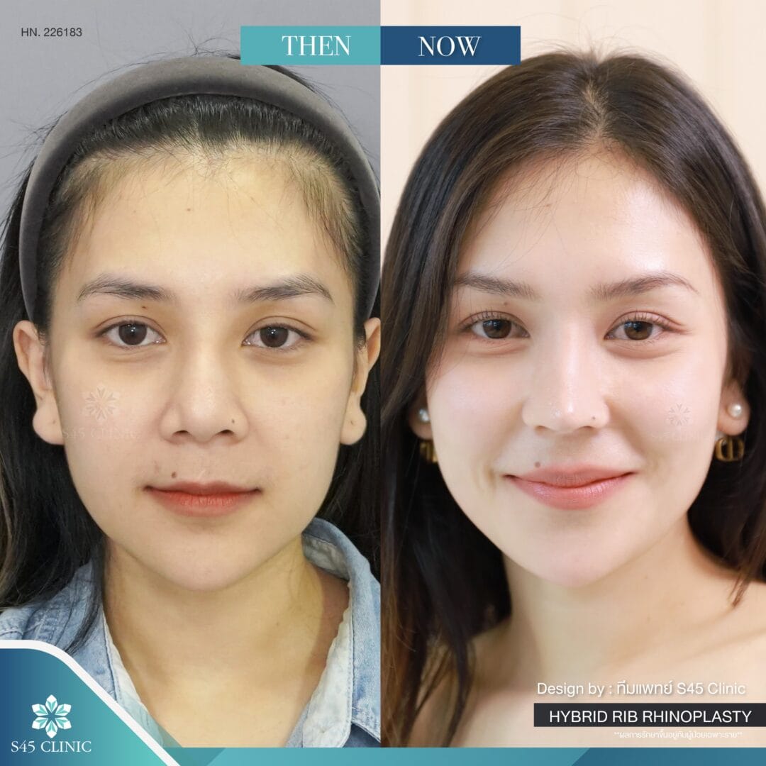 แก้จมูก รีวิวลูกค้าจริง