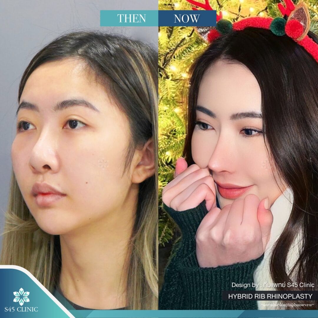 แก้จมูก รีวิวลูกค้าจริง