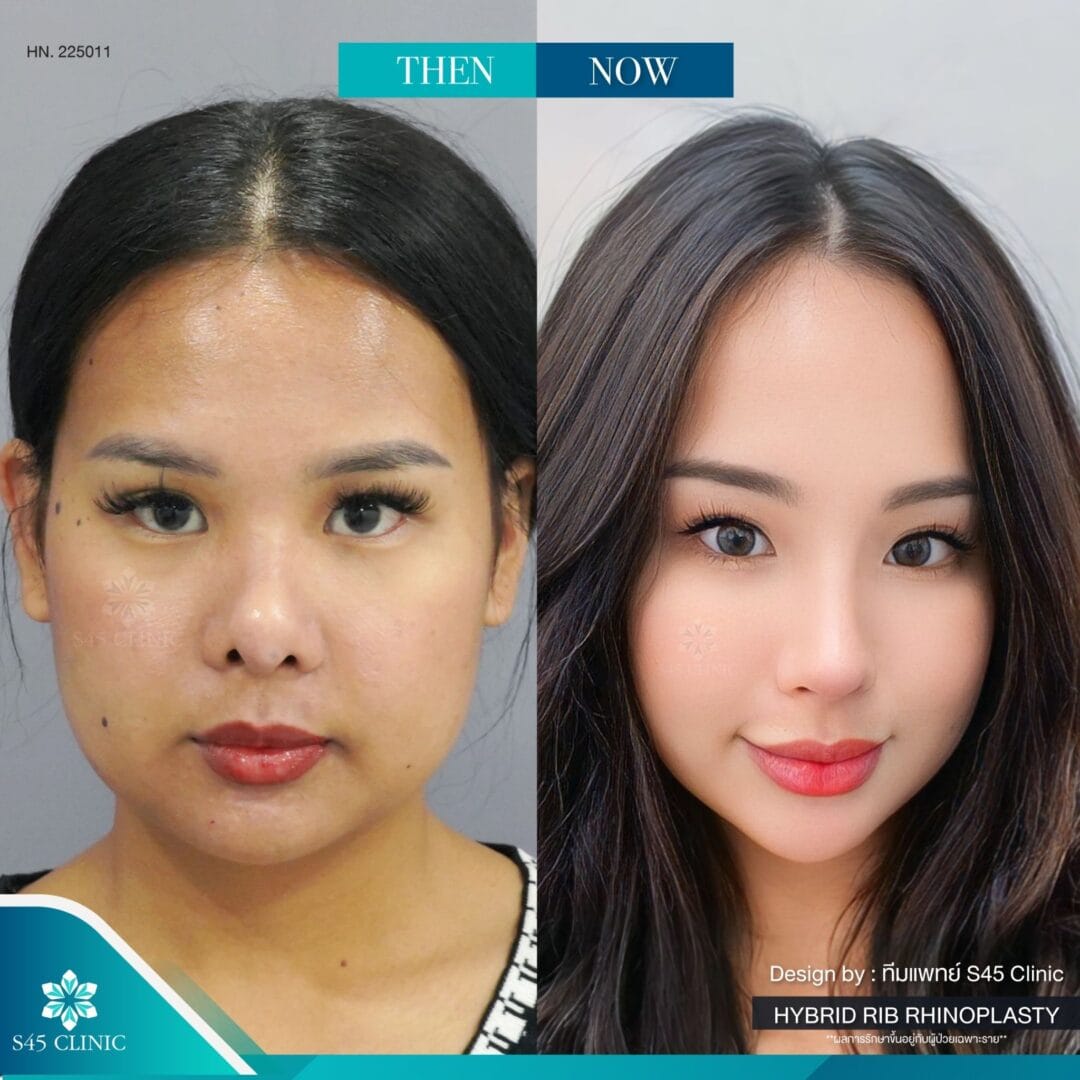 แก้จมูก s45 clinic