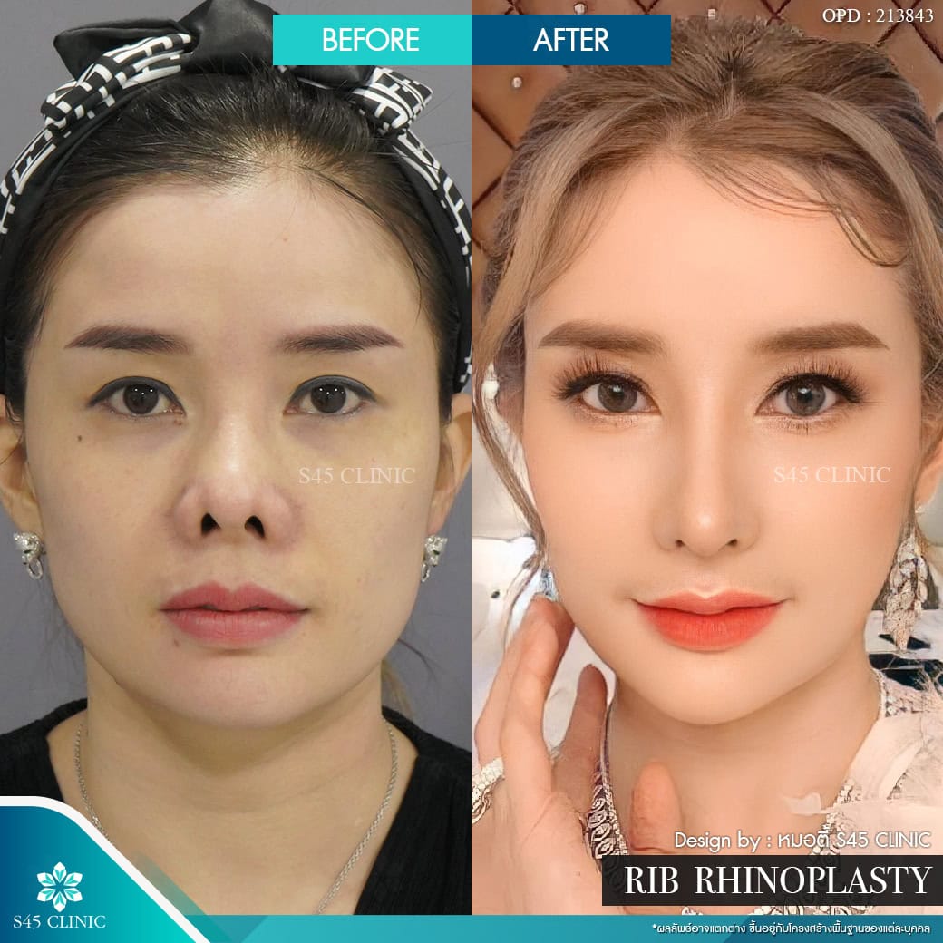 แก้จมูก s45 clinic