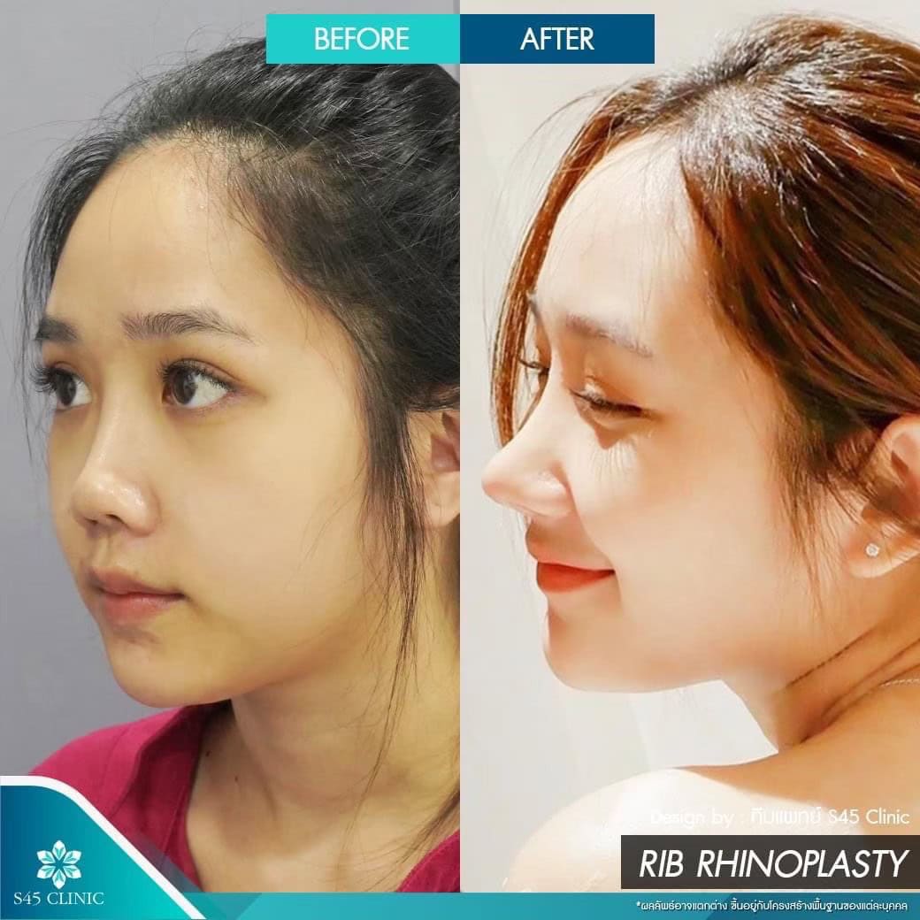 รีวิวแก้จมูก หมอบิ๊ก