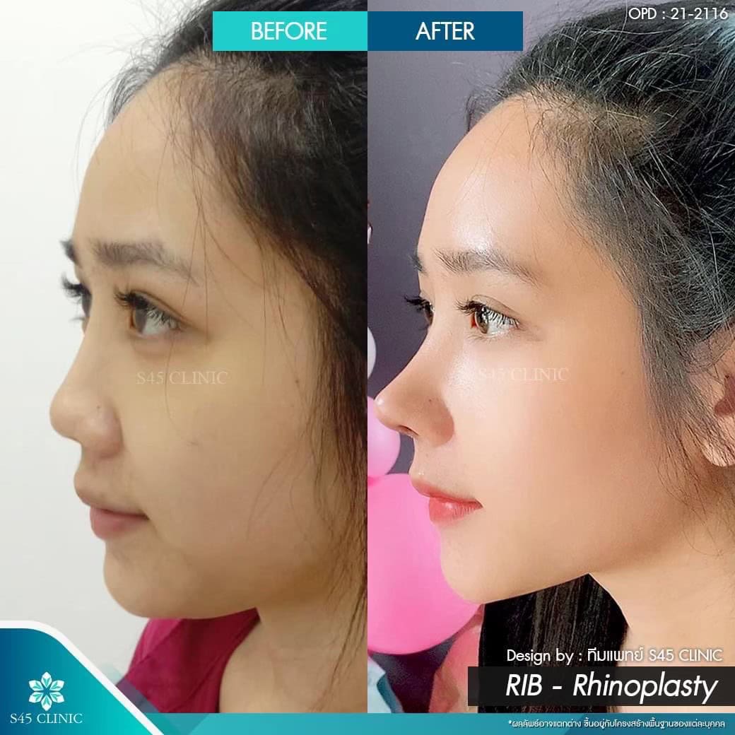 รีวิวแก้จมูก หมอบิ๊ก