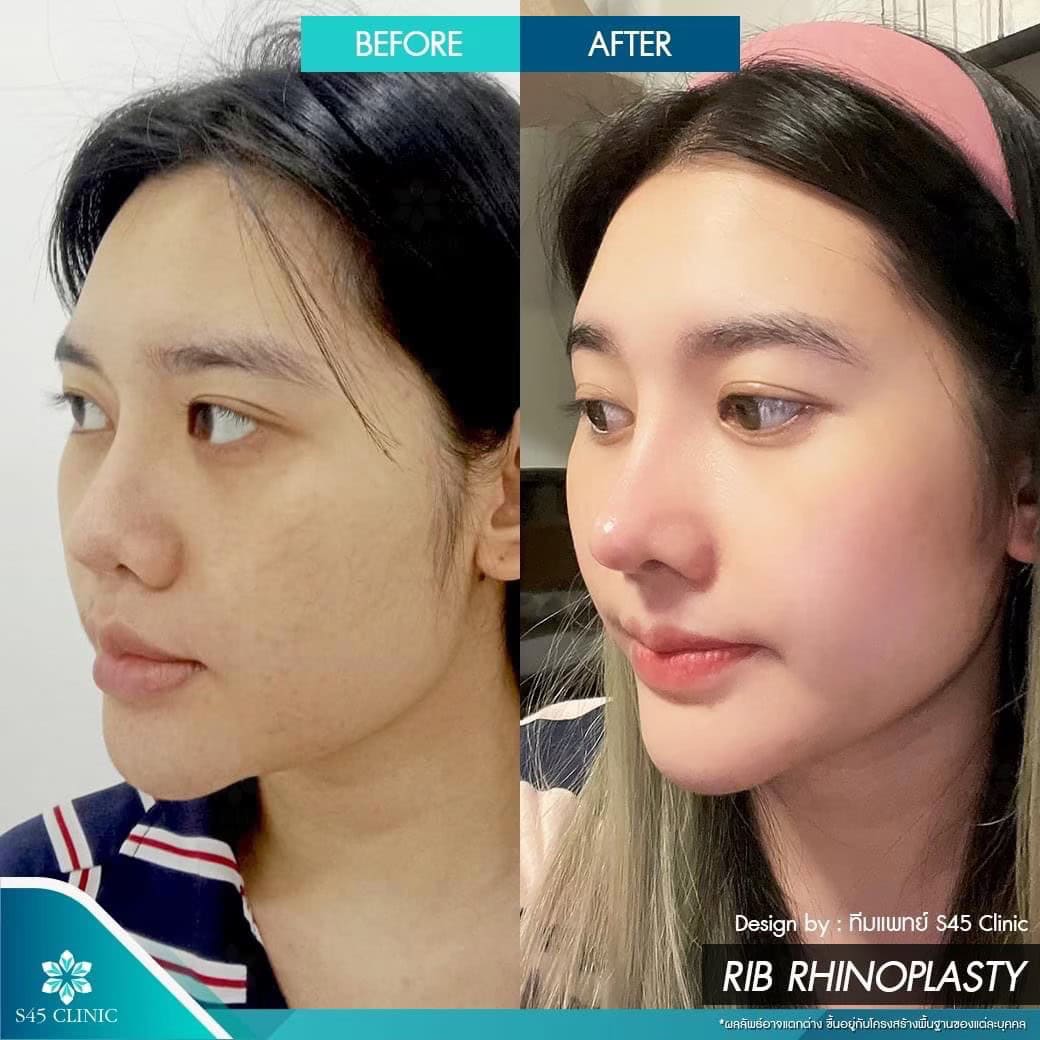 รีวิวแก้จมูก หมอบิ๊ก