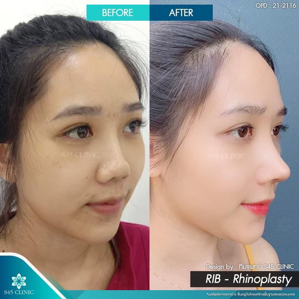 รีวิวแก้จมูก หมอบิ๊ก
