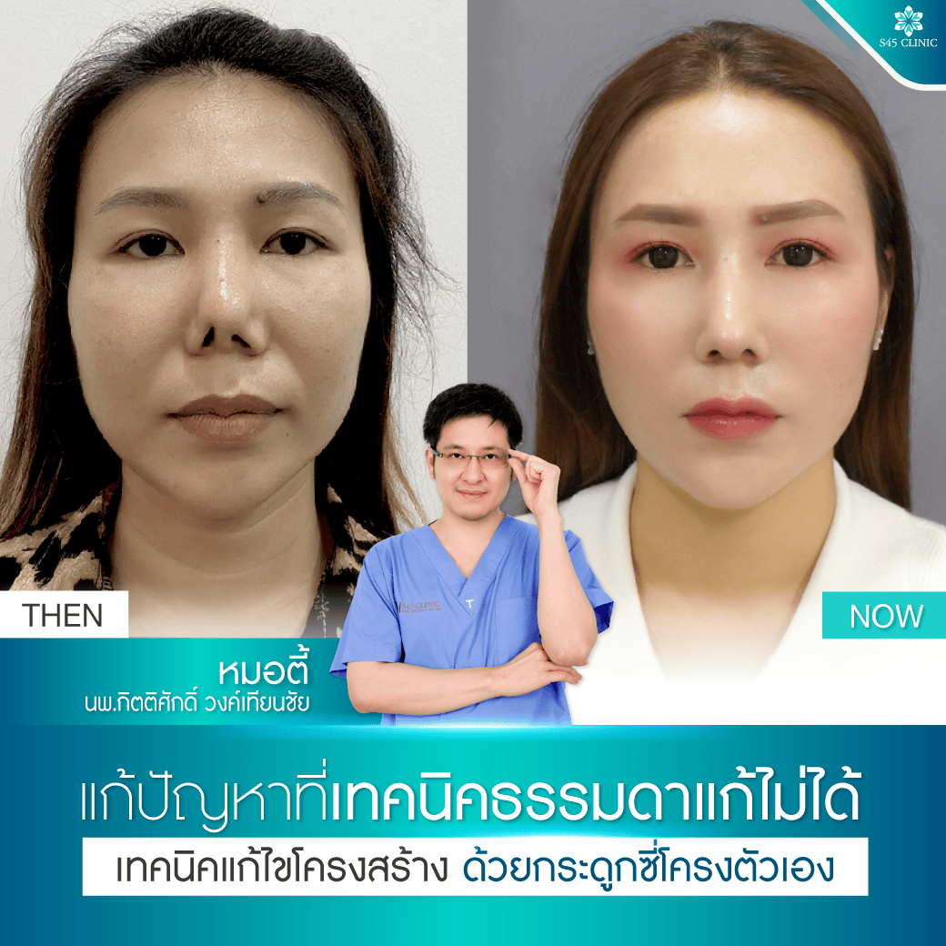 แก้ไขโครงสร้างจมูก