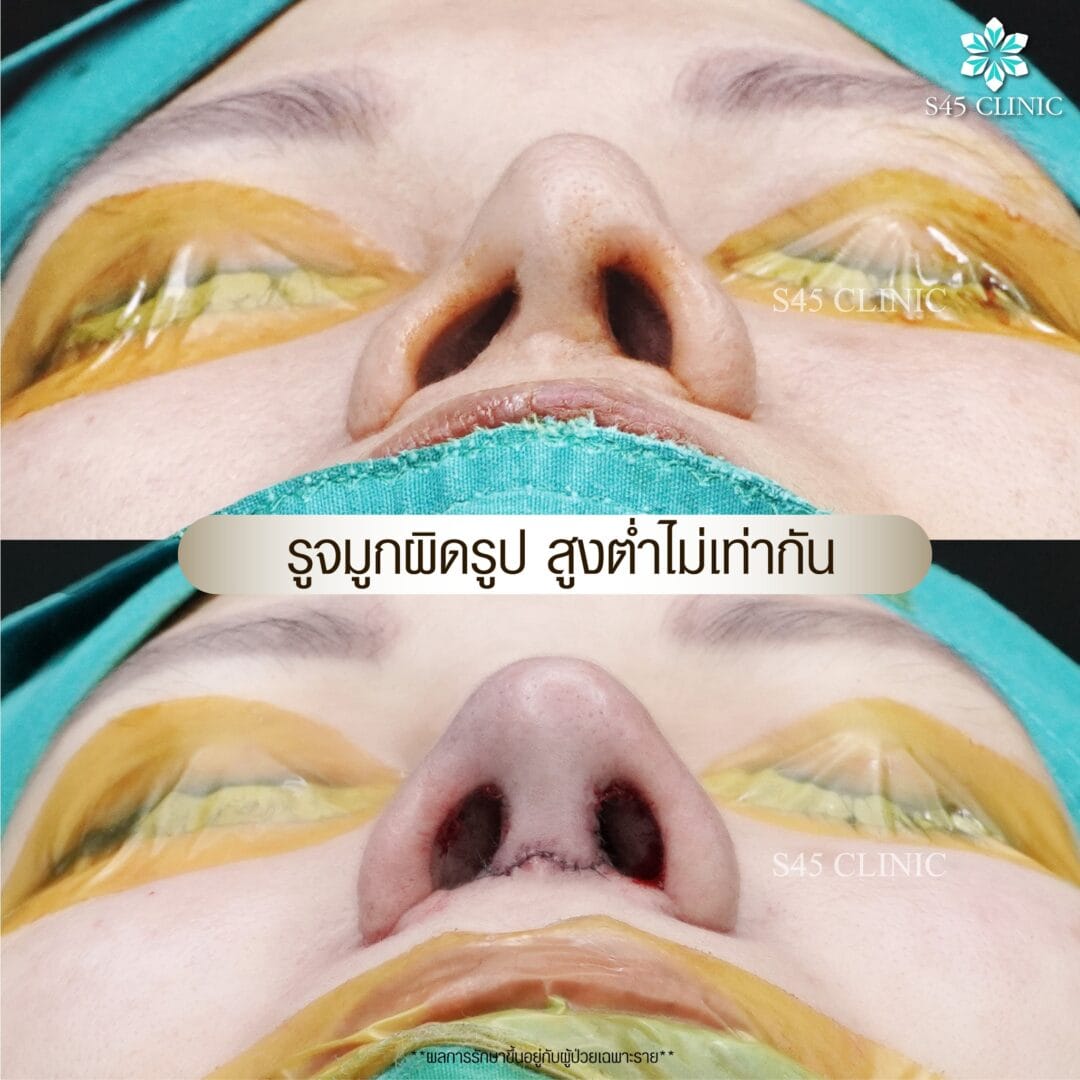 รีวิว แก้ไขรูจมูก