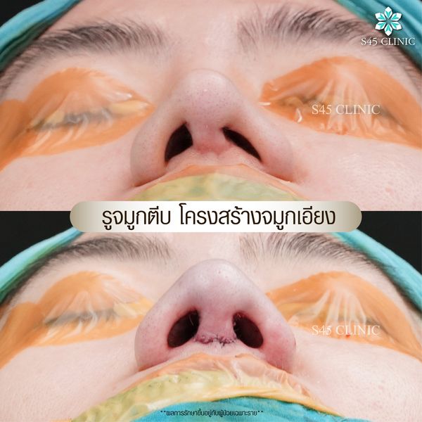 รีวิว แก้ไขรูจมูก