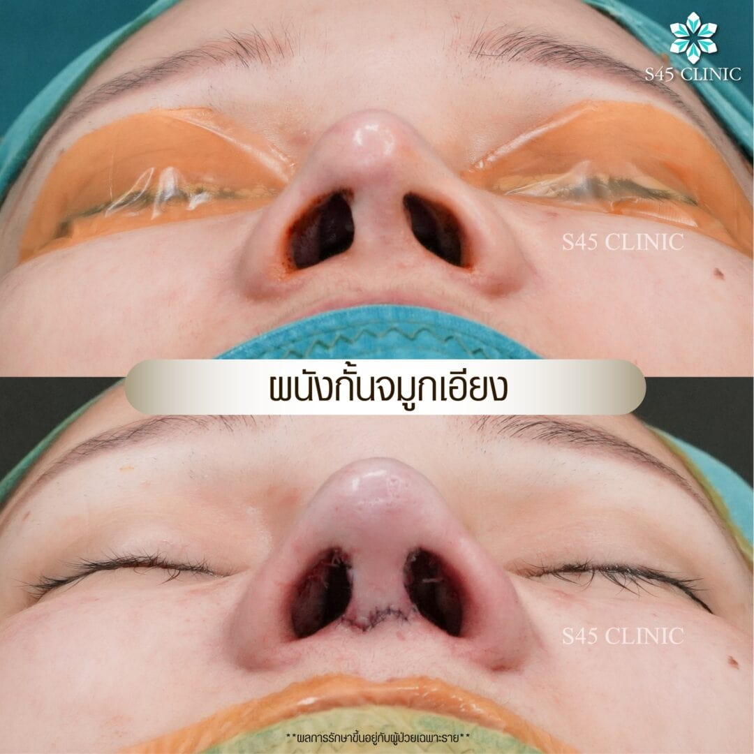 รีวิว แก้ไขรูจมูก
