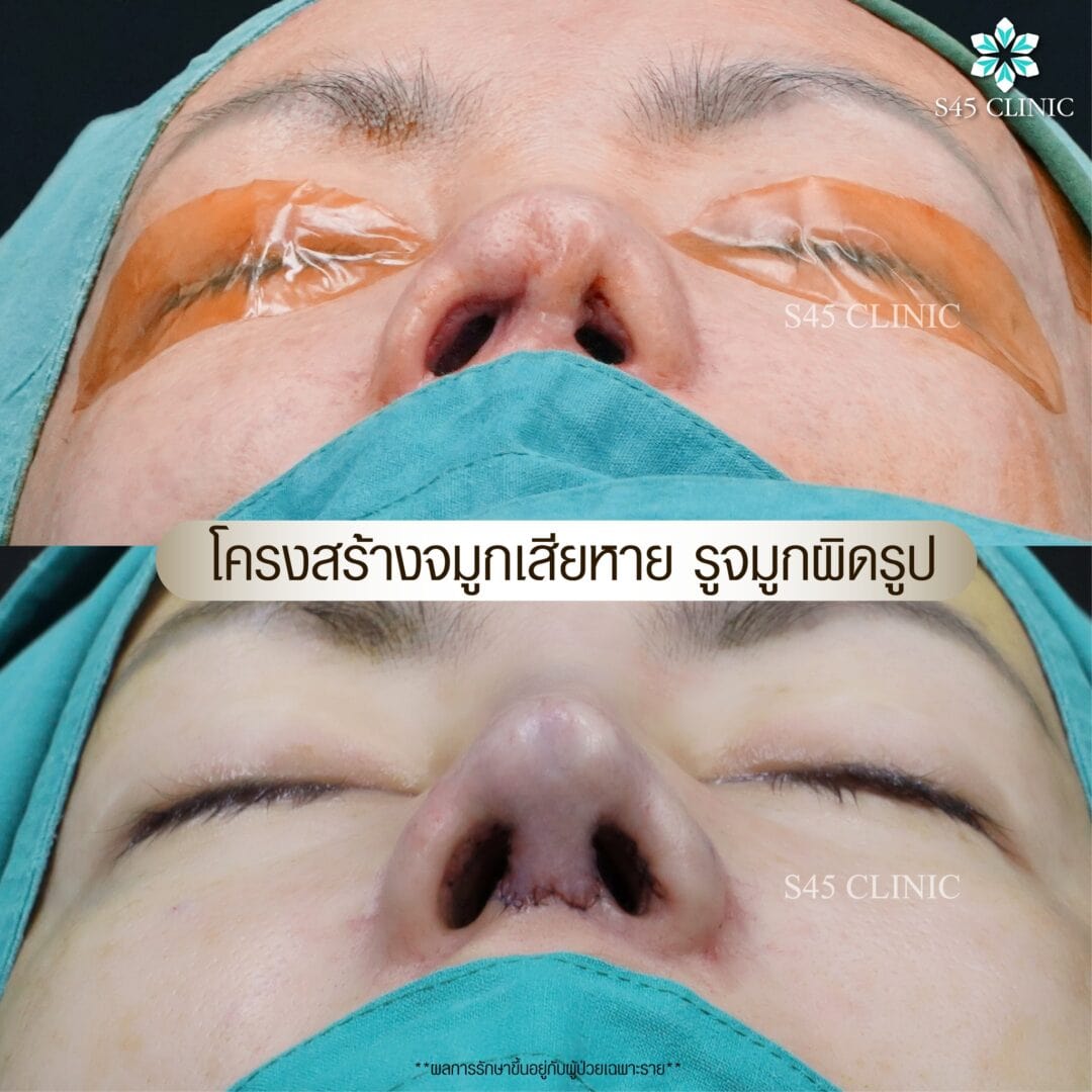 รีวิว แก้ไขรูจมูก