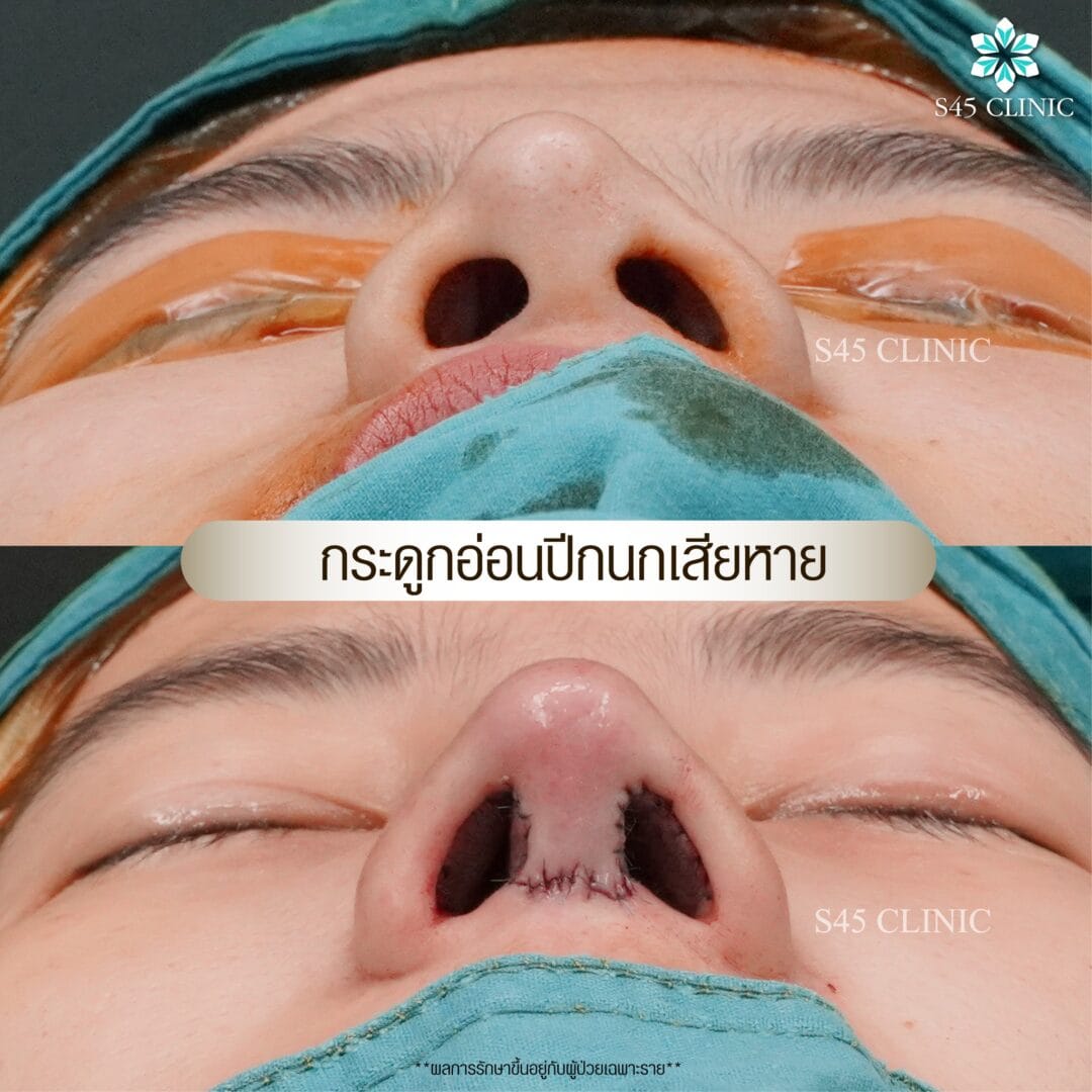 รีวิว แก้ไขรูจมูก