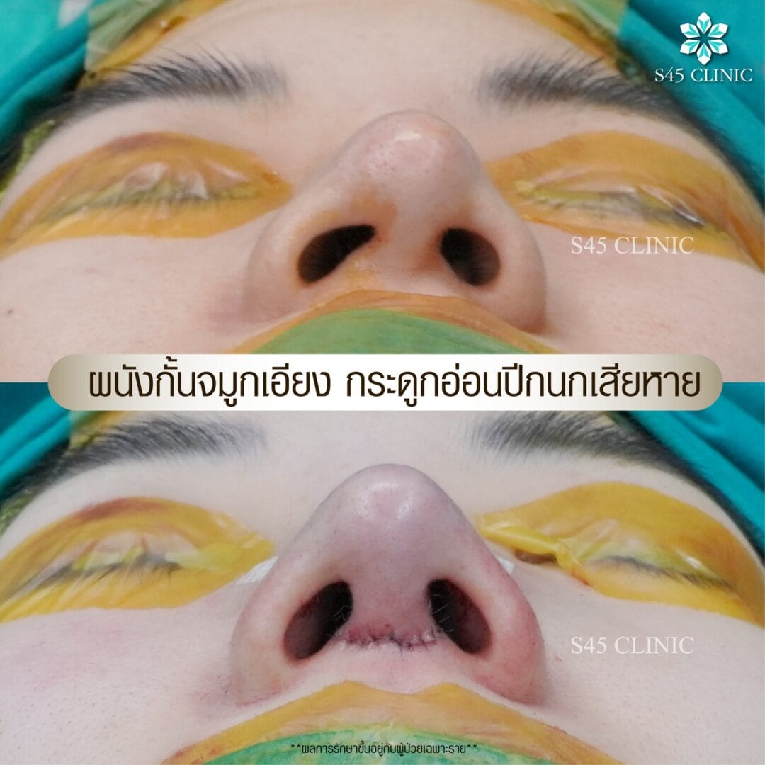รีวิว แก้ไขรูจมูก