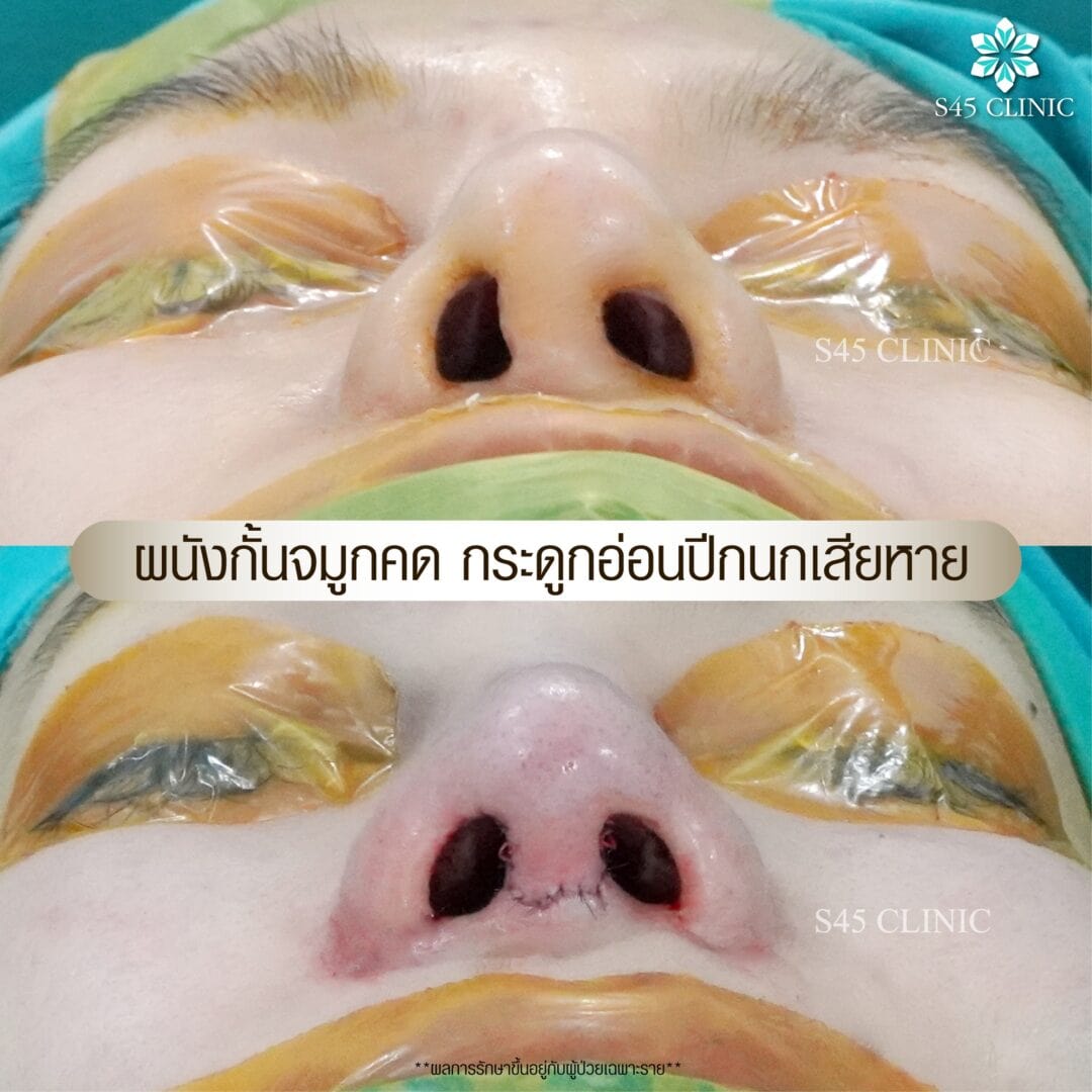 รีวิว แก้ไขรูจมูก