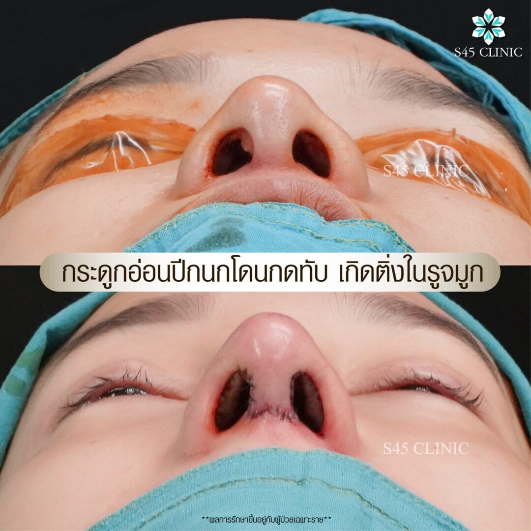 รีวิว แก้ไขรูจมูก