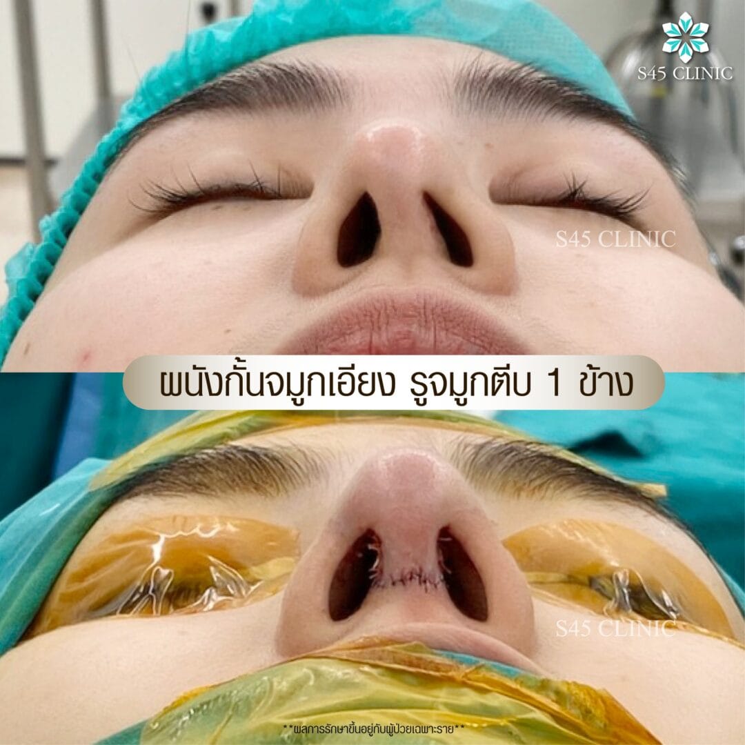 รีวิว แก้ไขรูจมูก