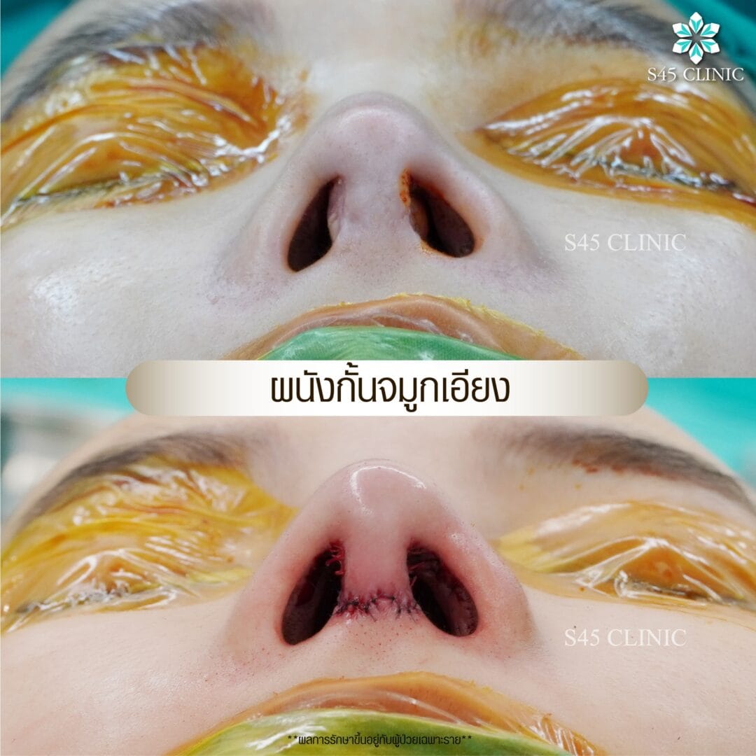 รีวิว แก้ไขรูจมูก
