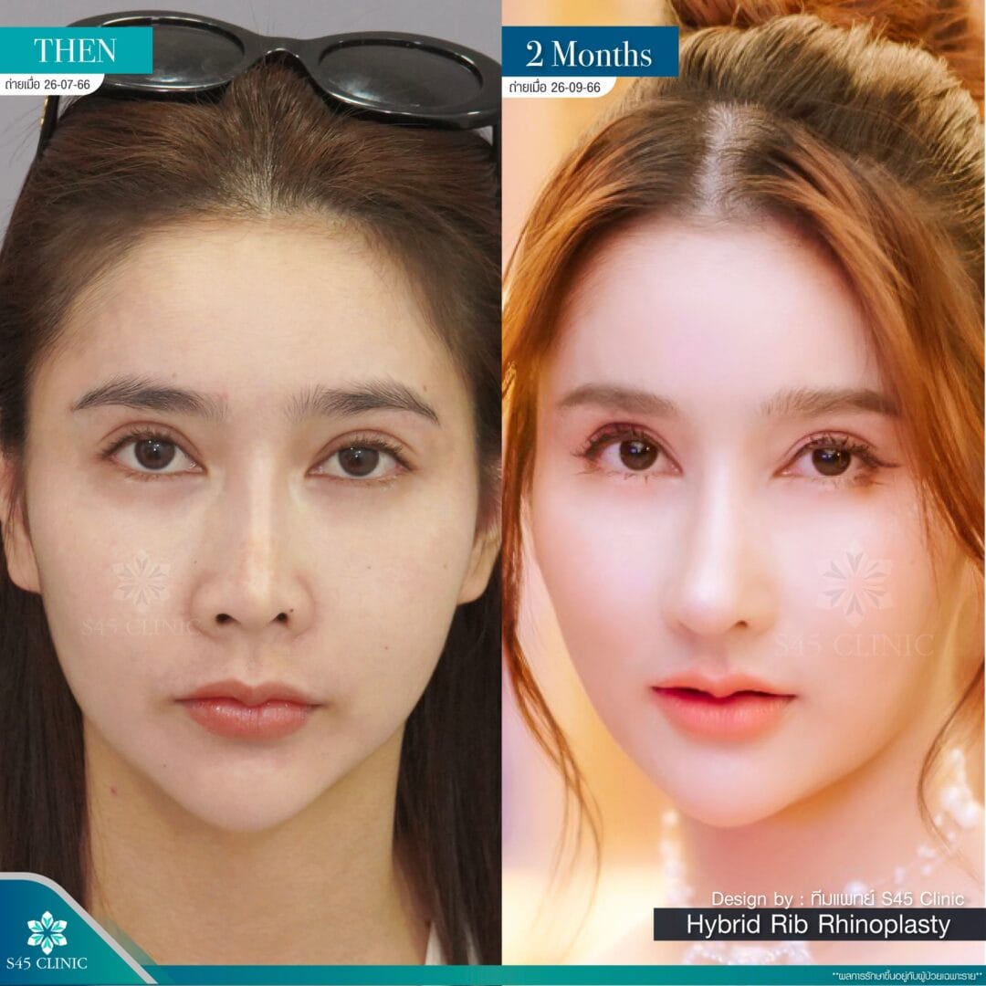 รีวิวแก้จมูก หมอบิ๊ก