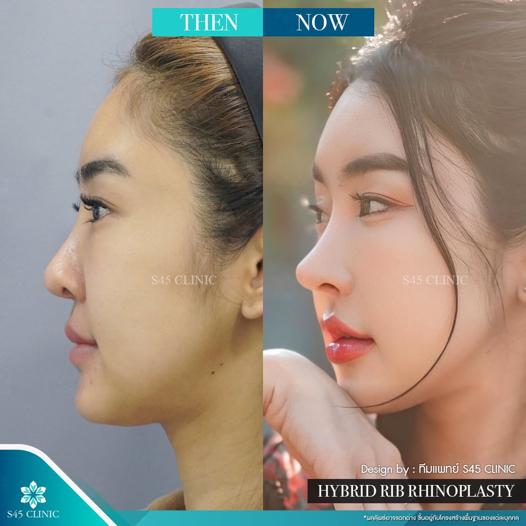 รีวิวแก้จมูก หมอบิ๊ก