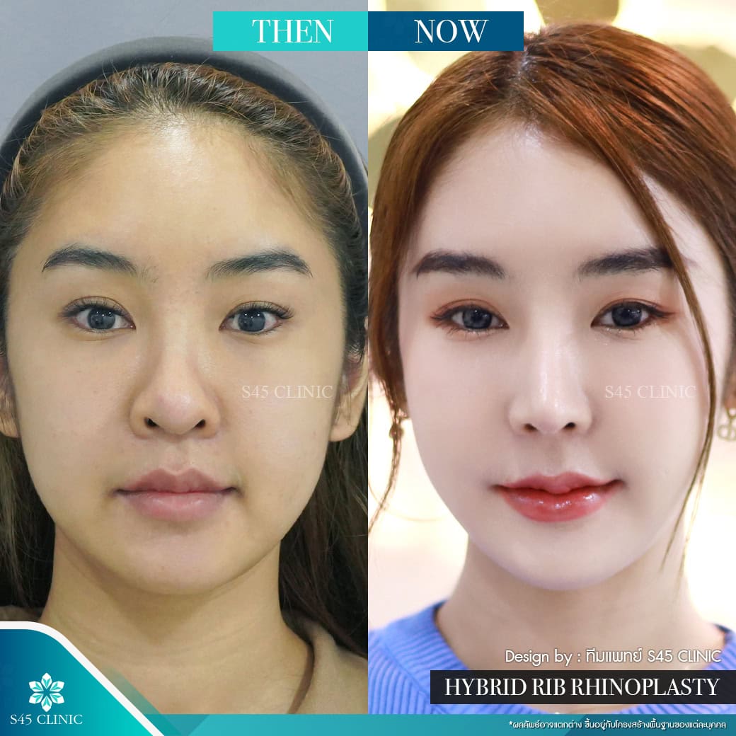 รีวิวแก้จมูก หมอบิ๊ก