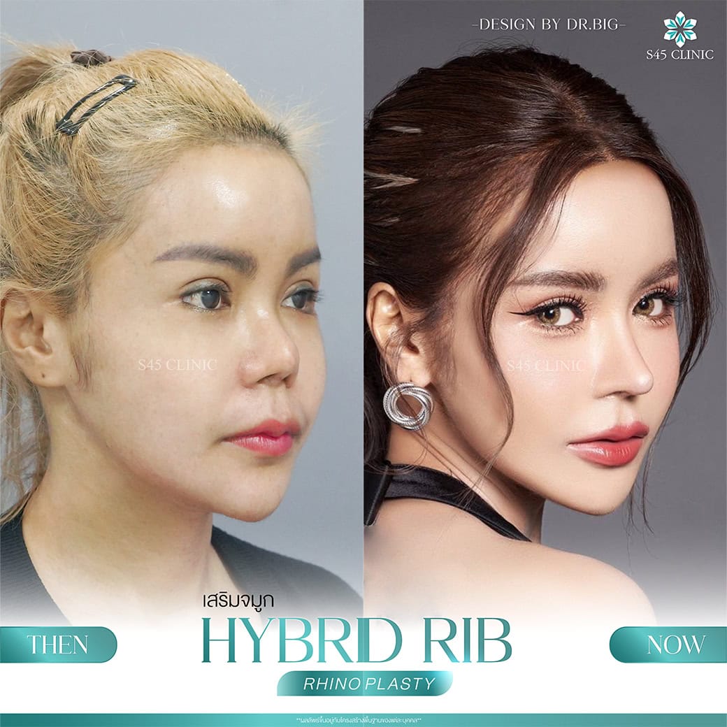 รีวิวแก้จมูก หมอบิ๊ก